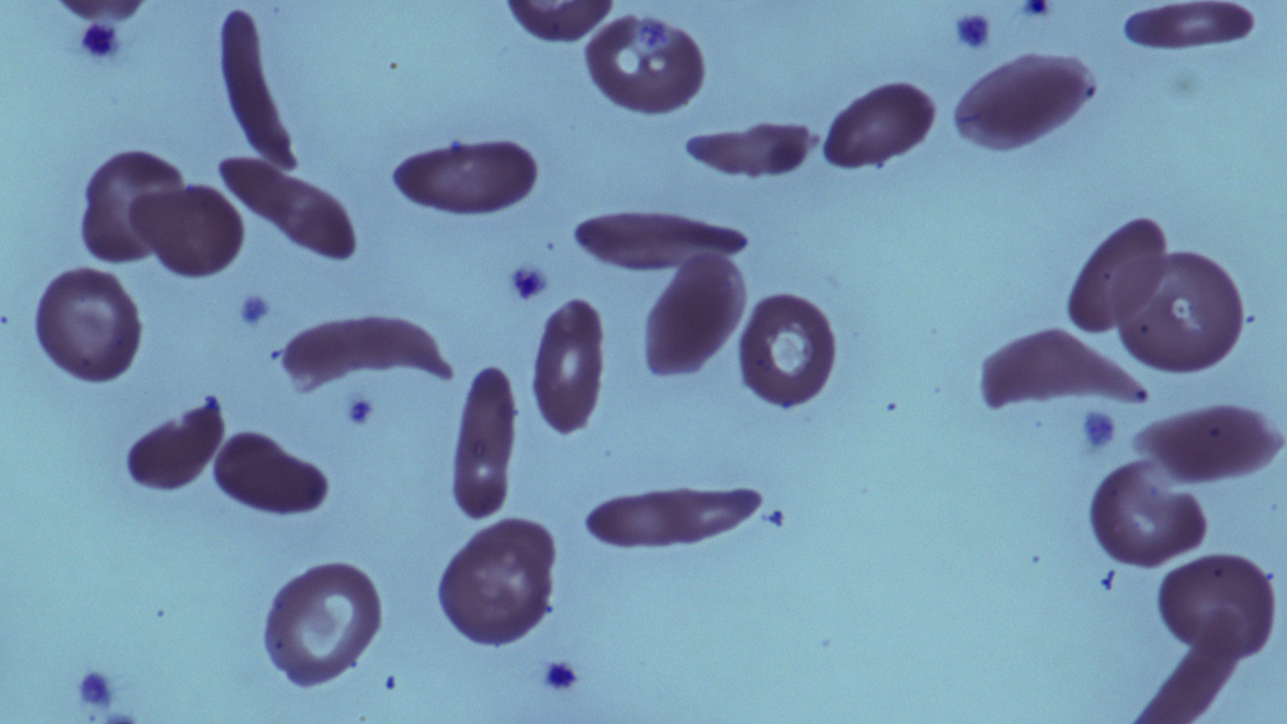 Sickle cell trait may not increase risk of premature death, study finds