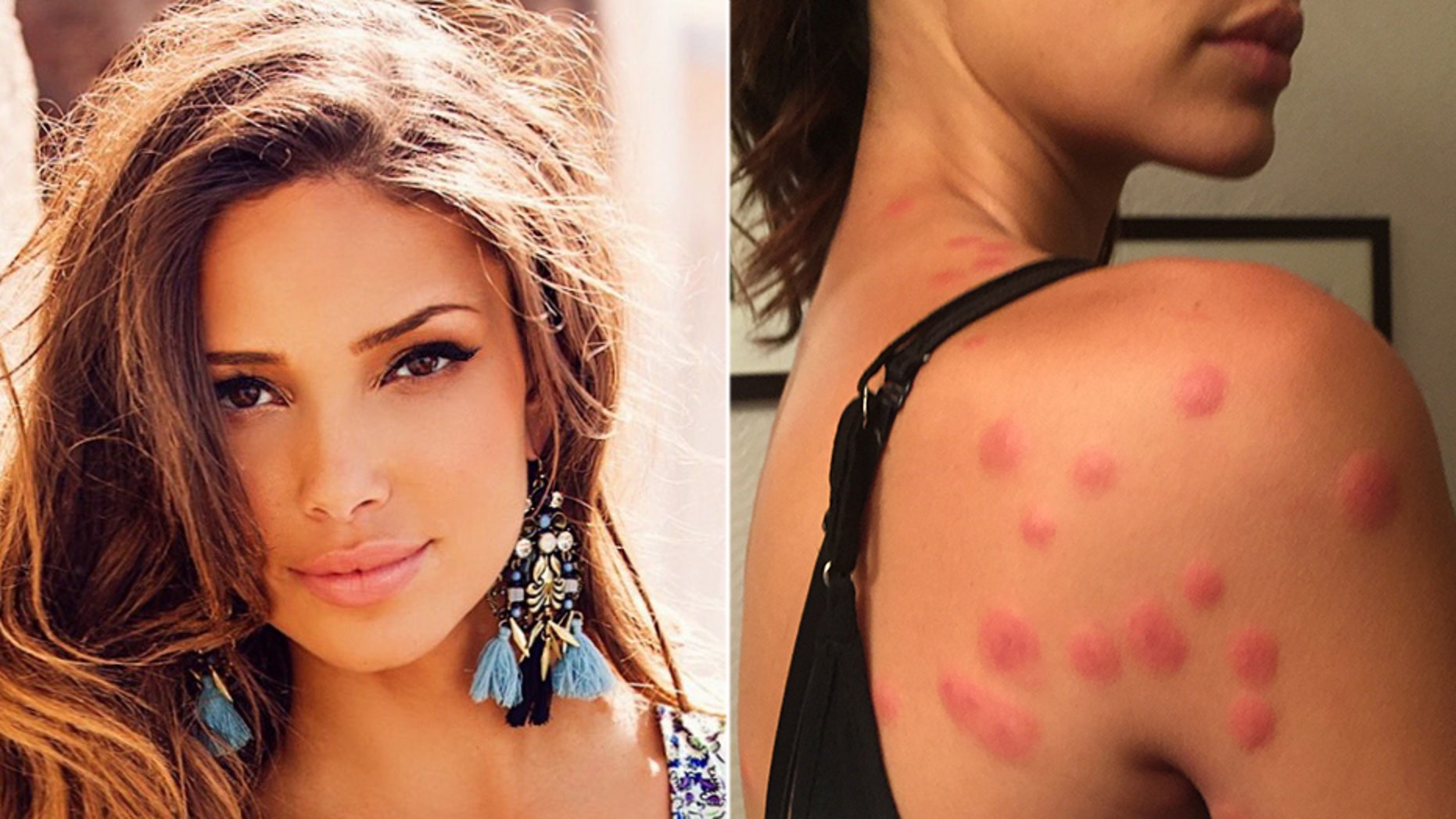 Sabrina Jales St. Pierre is suing the Palm Desert Embassy Suites after she was allegedly "massacred" by bed bugs during a stay in 2016.