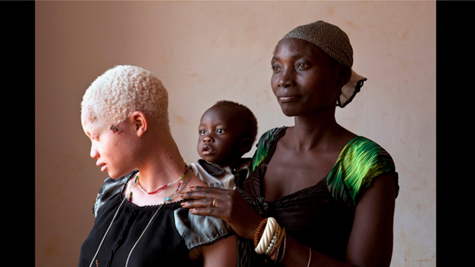 This photo taken Aug. 29, 2012 shows Angel Salvatory, 17, who has skin cancer, with her half-brother Ezekiel and mother Bestida, who she had not seen in the four years she has lived away from home, after her own father led a group of men to attack her, seen at Kabanga Protectorate Center, in Kabanga, Tanzania.