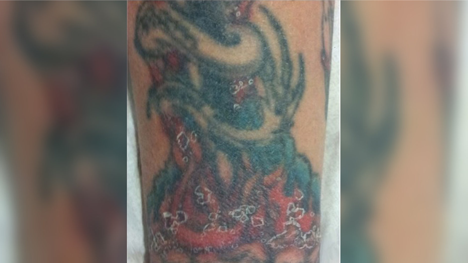 In this image of the patient's tattoo, skin lesions as a result of delayed reaction to red ink have healed, leaving peeling skin behind. Credit:
BMJ Case Reports 2014