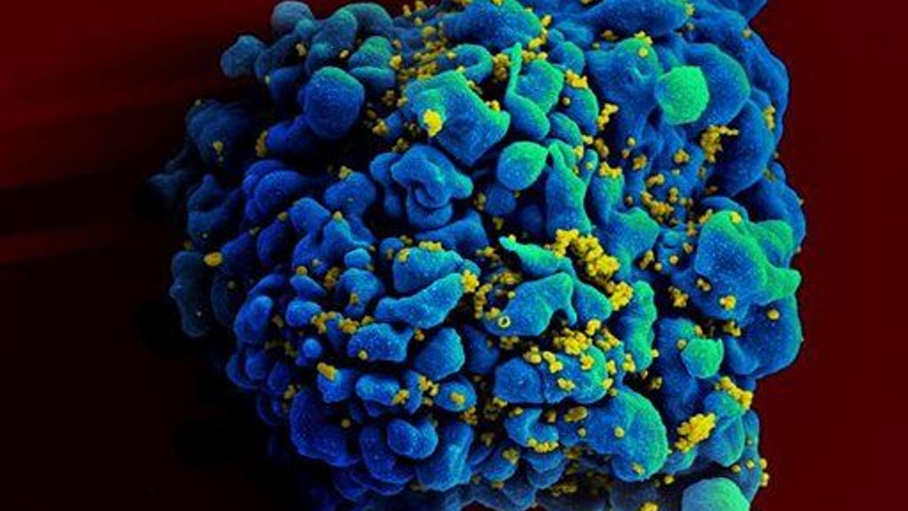 This electron microscope image made available by the National Institute of Allergy and Infectious Diseases shows an H9 T cell, colored in blue, infected with HIV, yellow.