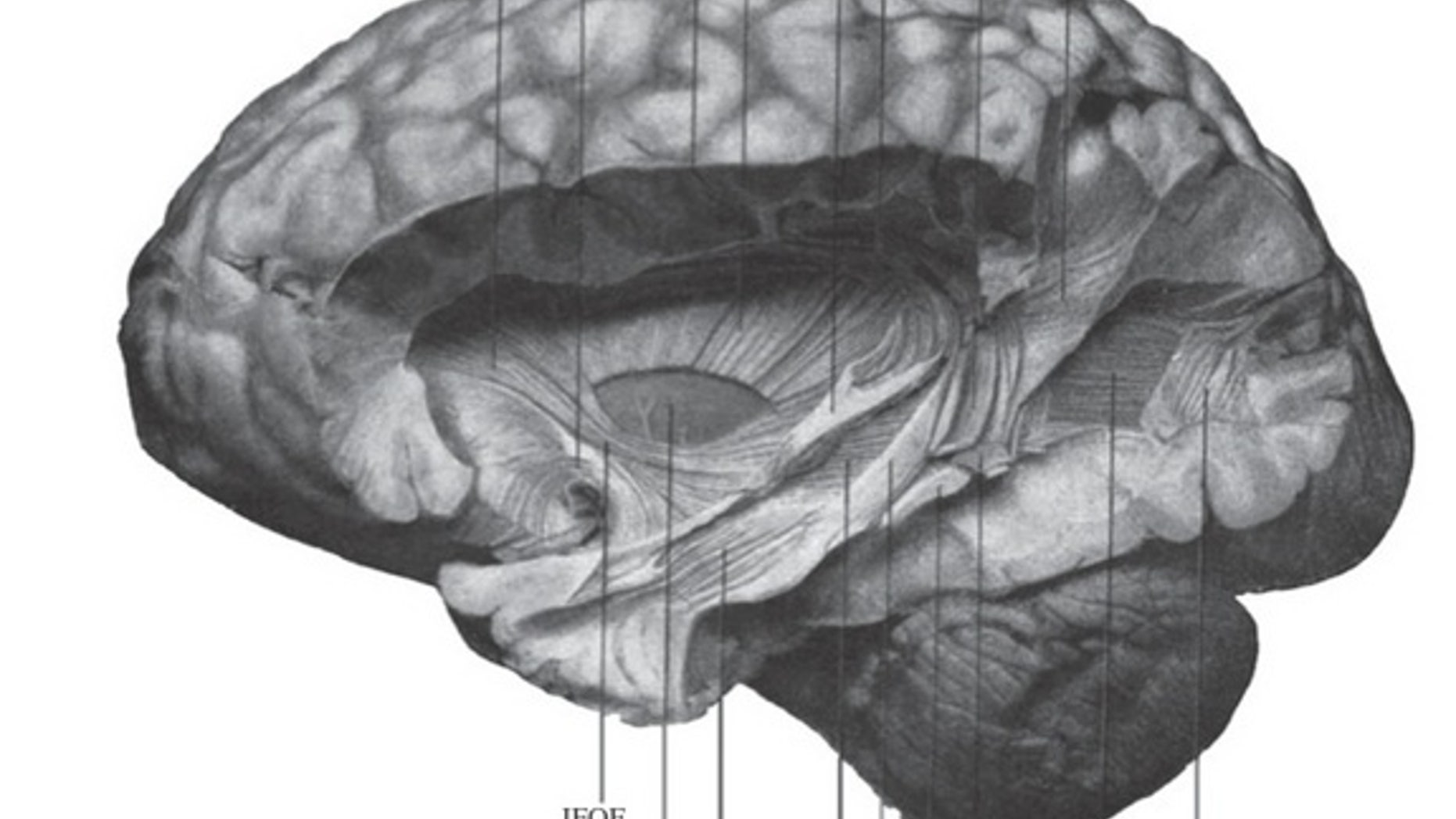 A drawing of a postmortem brain that includes the vertical occipital fasciculus (bottom left) published by neuroscientist E.J. Curran in 1909.