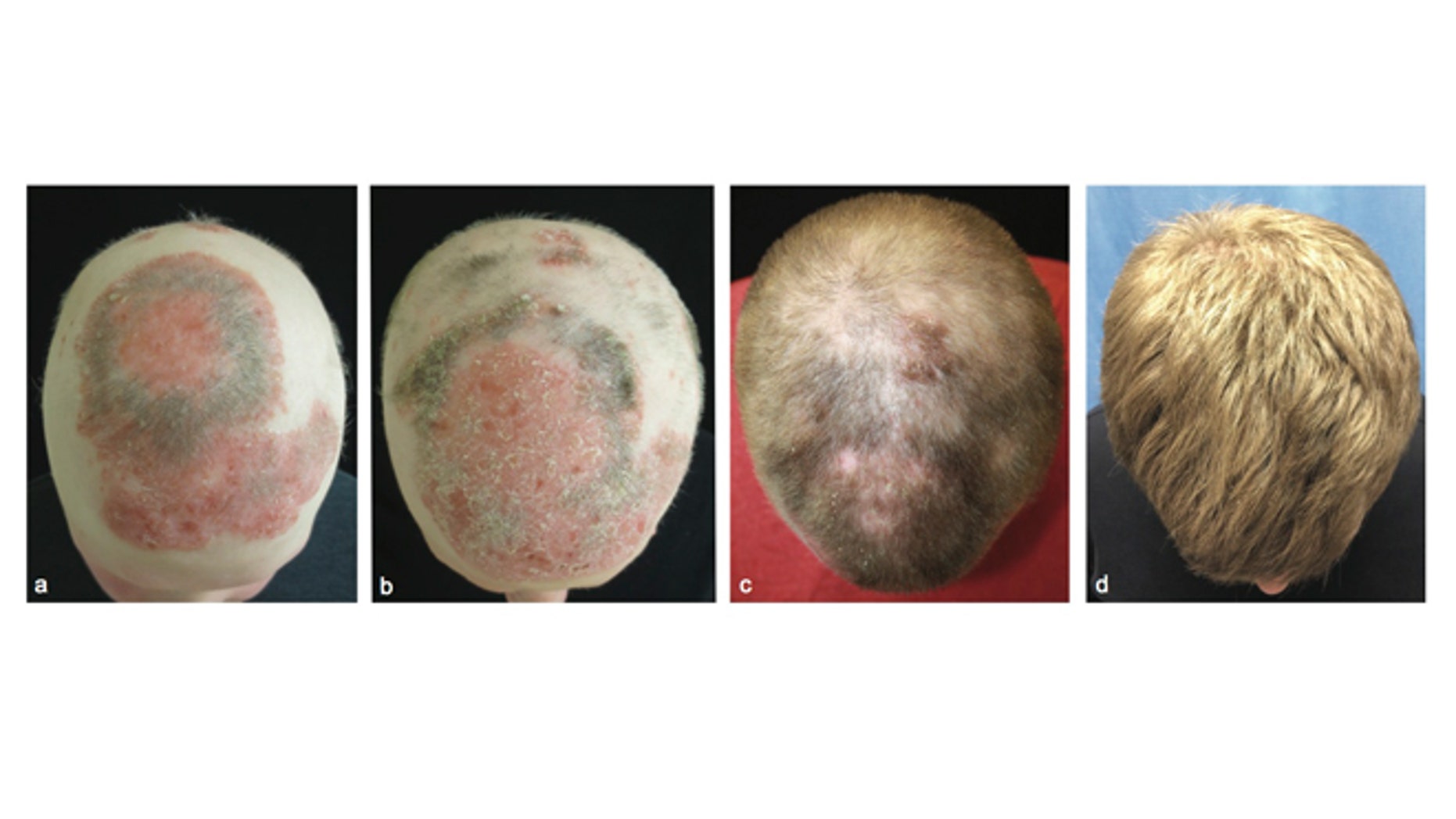 Images showing the alopecia patient during treatment with tofacitinib to regrow his hair. 1st panel- before treatment. 2nd panel- 2 months into treatment. 3rd panel- 5 months into treatment. 4th panel- 8 months into treatment.