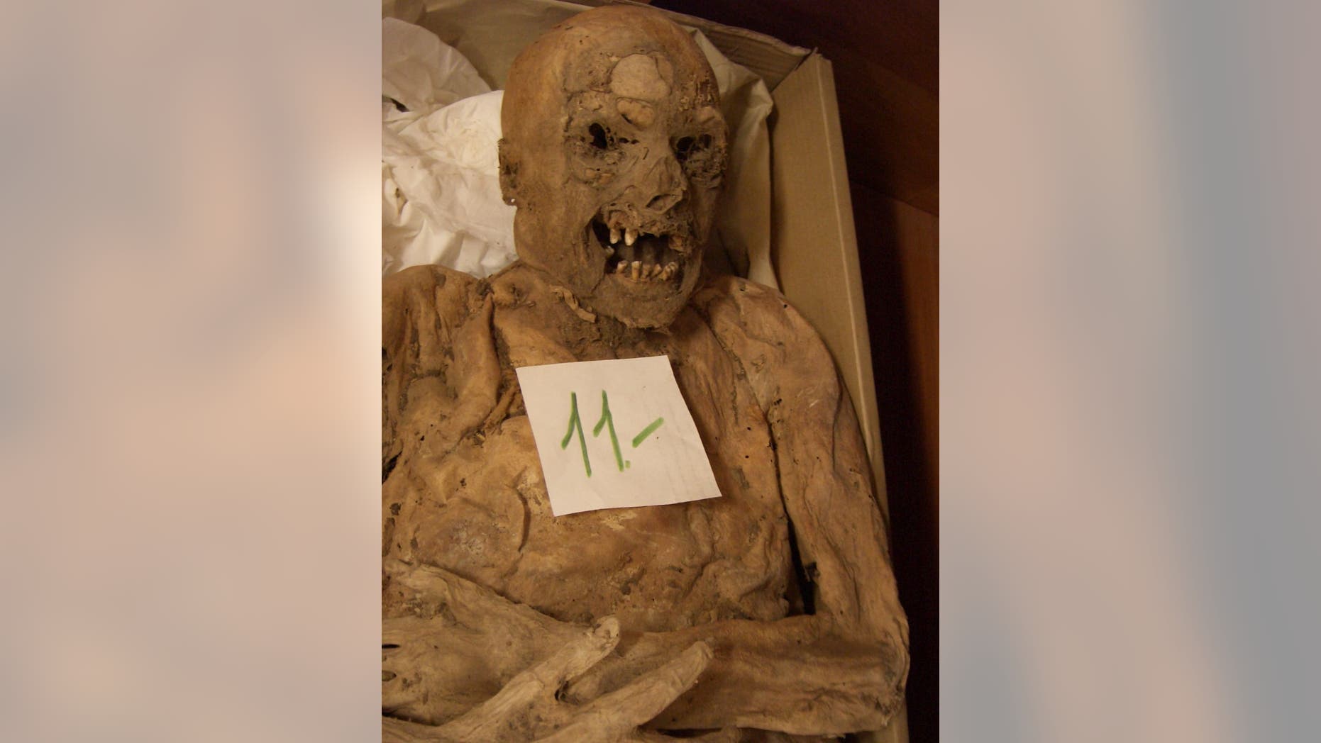 A Hungarian mummy's genes is helping scientists better understand the causes of colorrectal cancer. (Tel Aviv University)