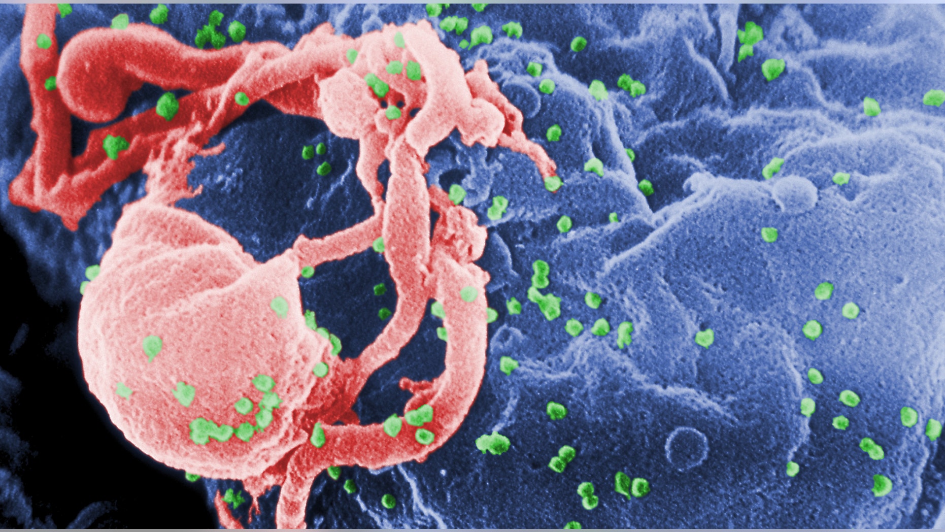 Scanning electron micrograph of HIV-1 budding from cultured lymphocyte. The multiple round bumps on cell surface represent sites of assembly and budding of virions.