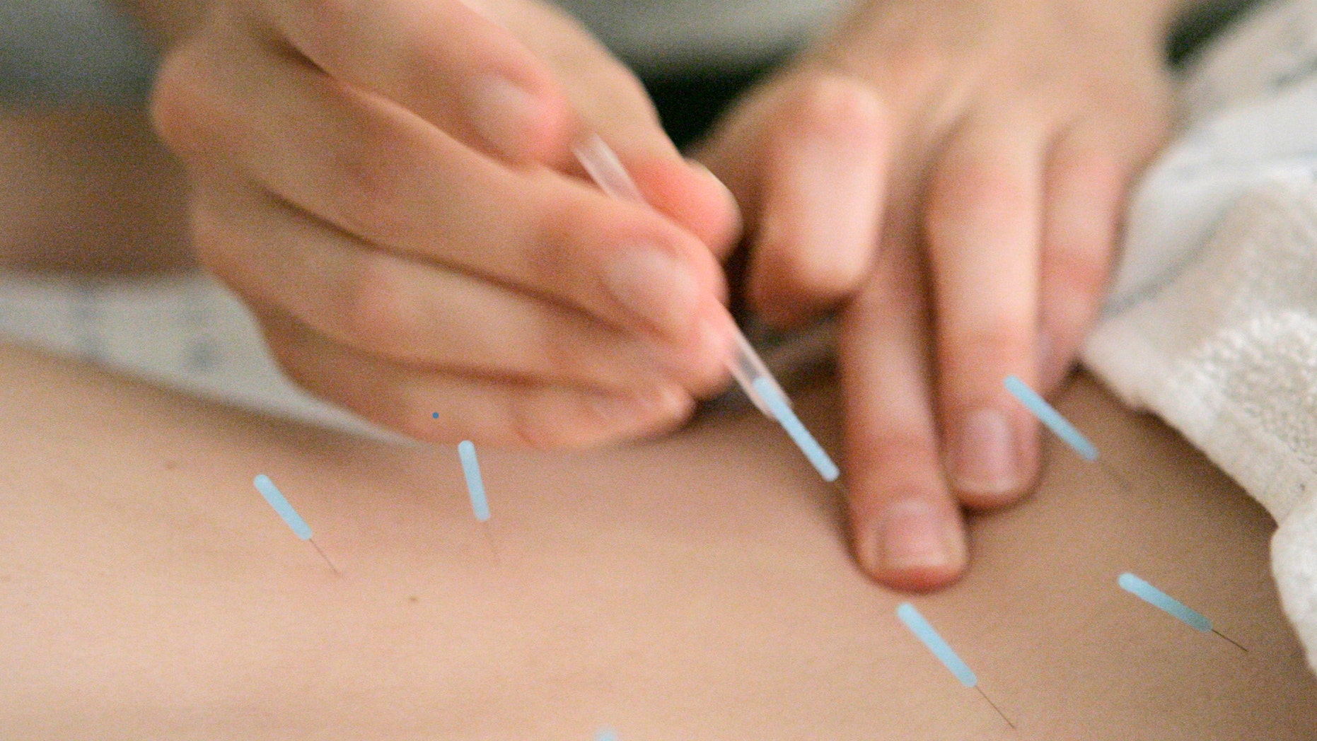 Anah McMahon, L. Ac. adjusts one inch seirin acupuncture needles in the muscles around the spine of Mariah VanHorn to relieve lower back pain, Monday, Sept. 24, 2007, at the Pacific College of Oriental Medicine in Chicago. Researchers at Ruhr University Bochum in Bochum, Germany, found that both real and fake acupuncture perform much better than conventional care for low back pain relief. (AP Photo/M. Spencer Green)