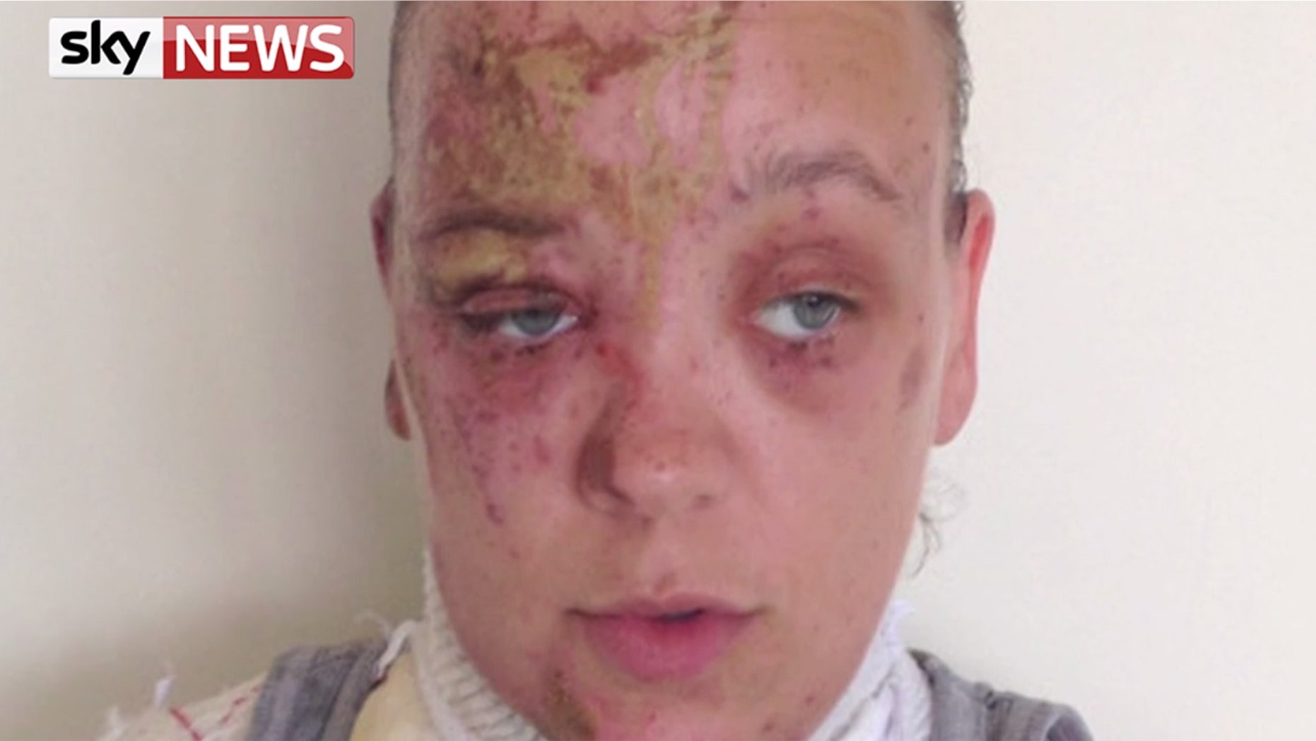 Tara Quigley said she still has nightmares of the acid attack.