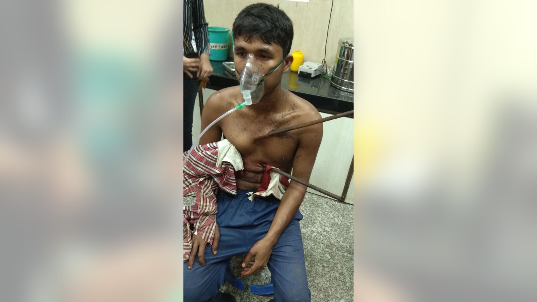 Doctors saved the life of a 21-year-old man who fell off a building and got himself impaled on iron rods that pierced his chest.
