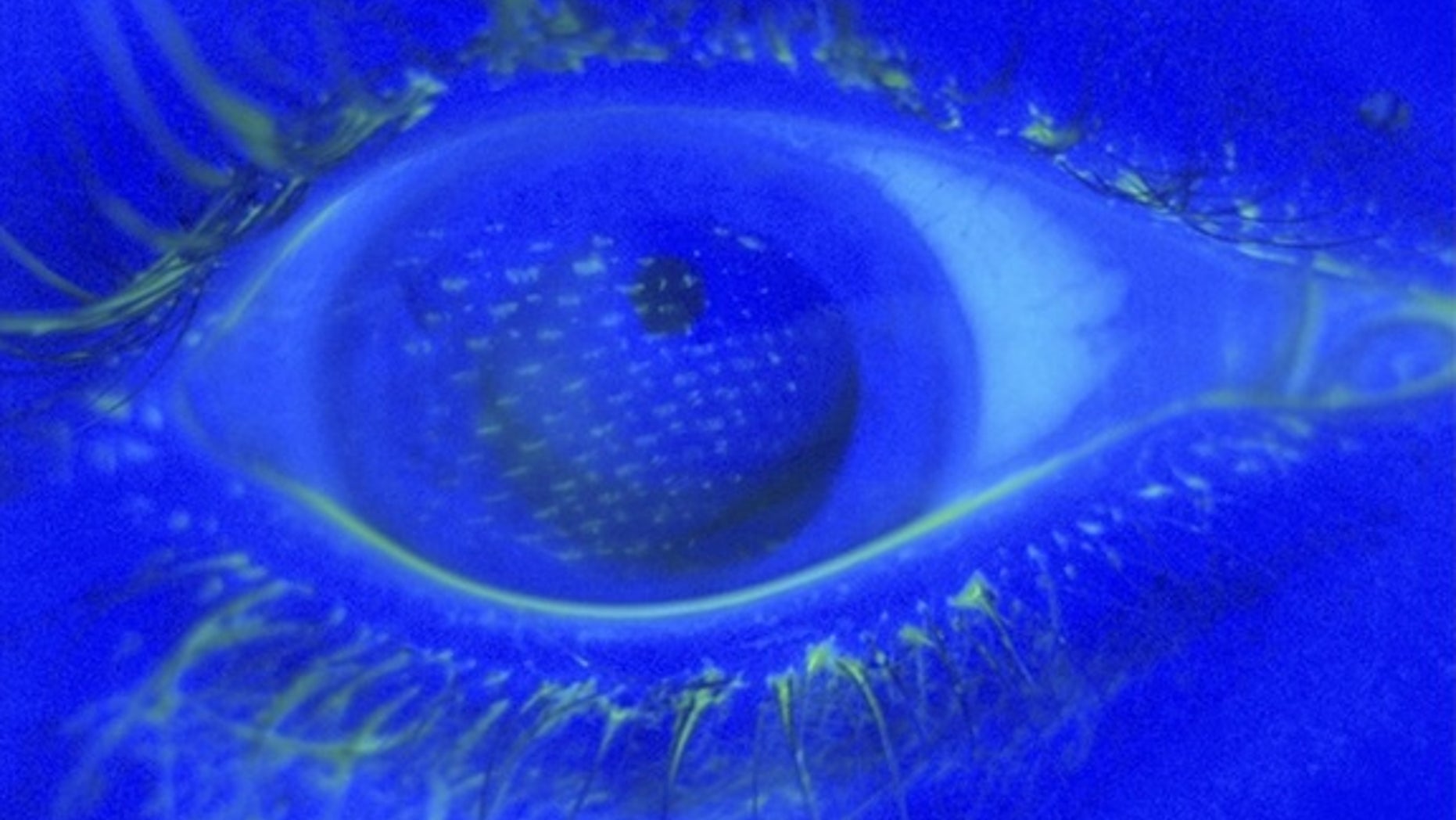 Under a blue light, fluorescein staining of the eye reveals an imprint of the nylon mesh pattern of the airbag cover on the corneal surface of the right eye.