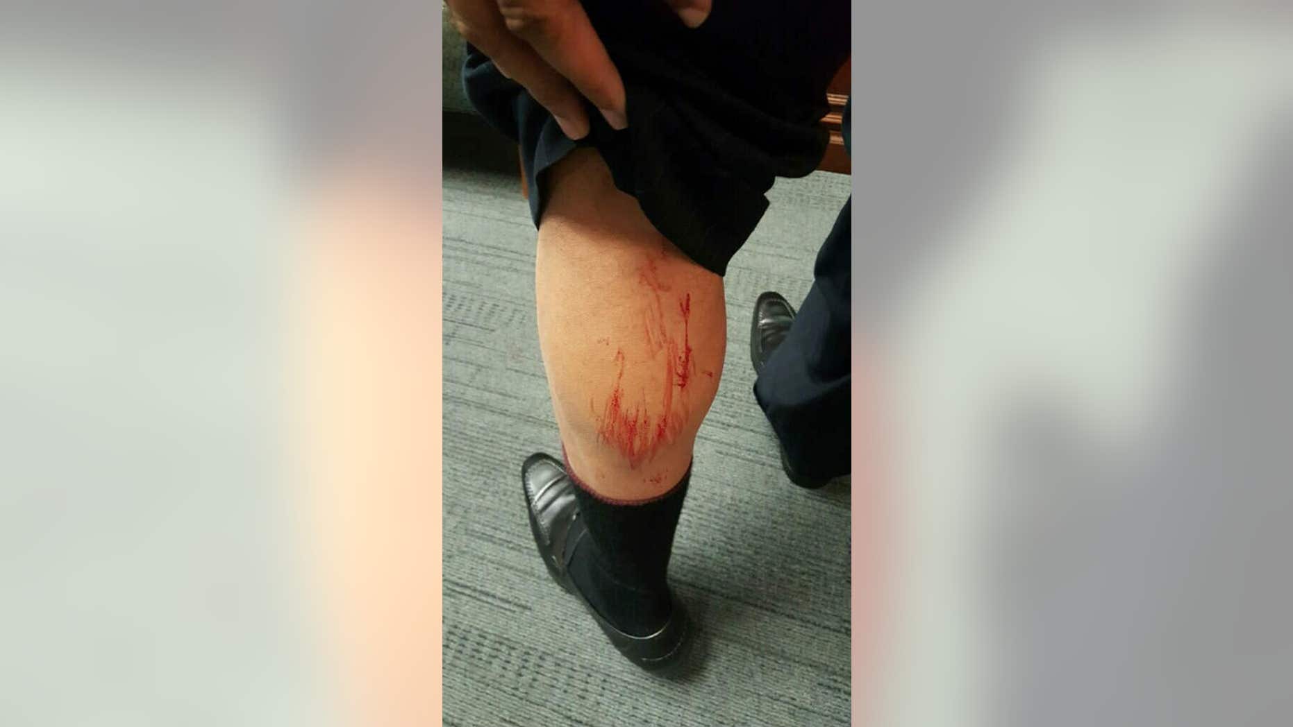 City Councilman Marcus Lundy's leg after the fight.