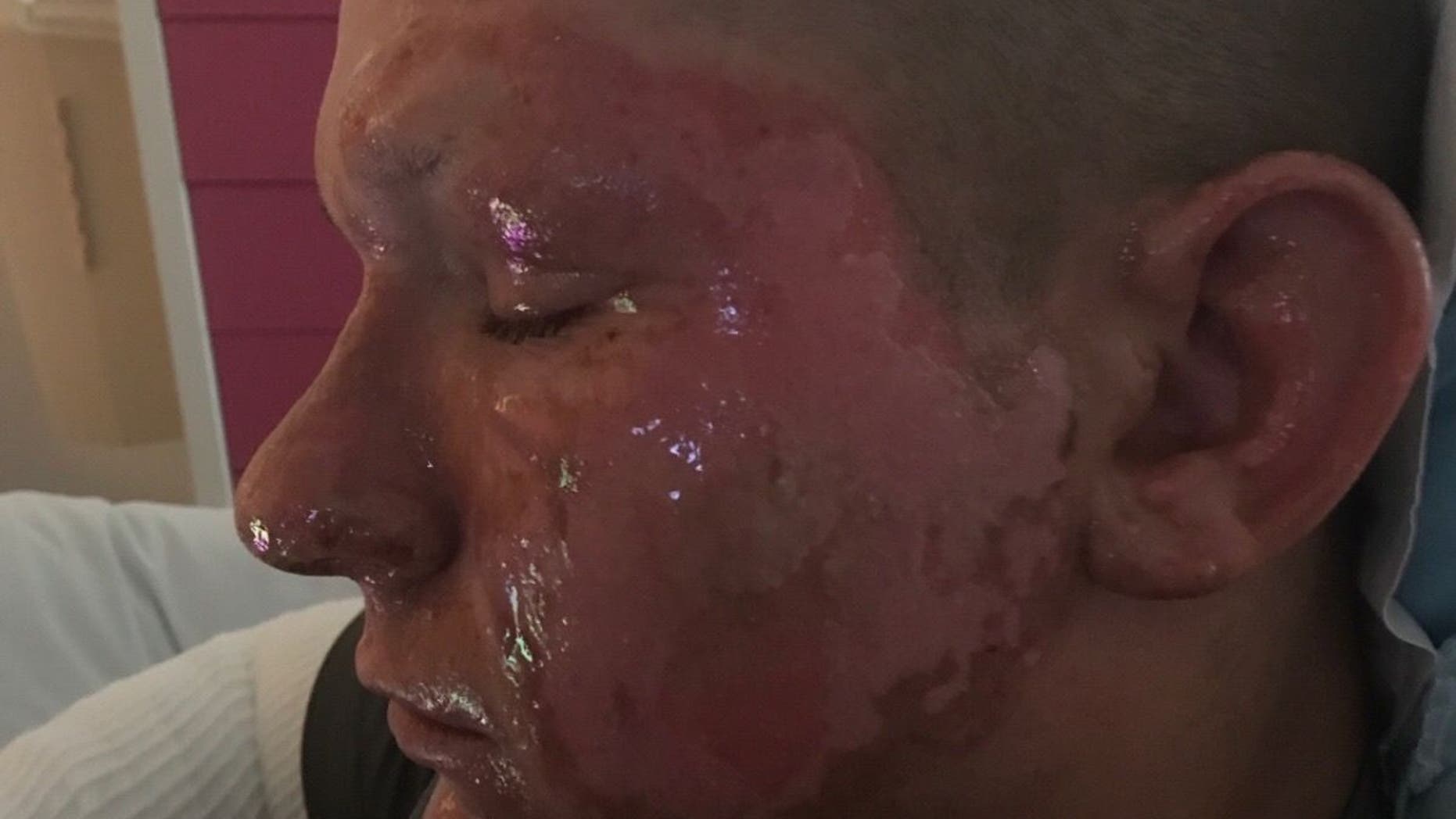 A Virginia teen is recuperating after he was burned by hogweed.