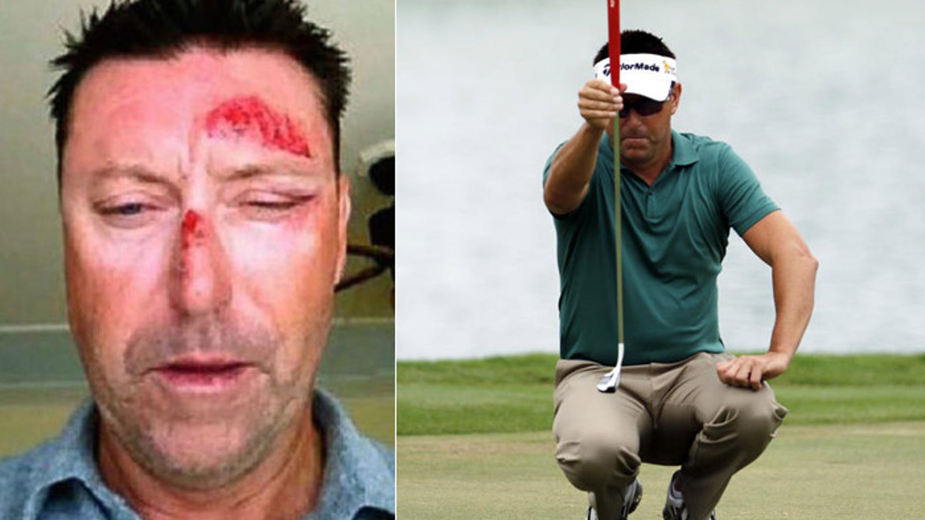 A photo Allenby tweeted following the incident shows facial injuries. He has pulled out of his next tournament. (Twitter, AP)