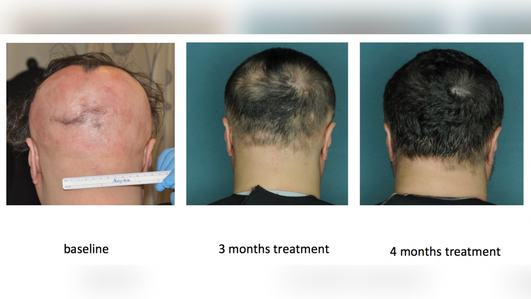 Researchers Find Miracle Cure For Baldness Fox News