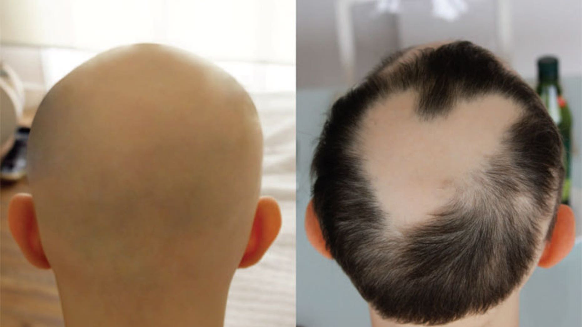 An image of a patient with alopecia universalis, a condition that results in hair loss. On the left, the patient's head before treatment with the drug tofacitinib. On the right, the head after treatment.