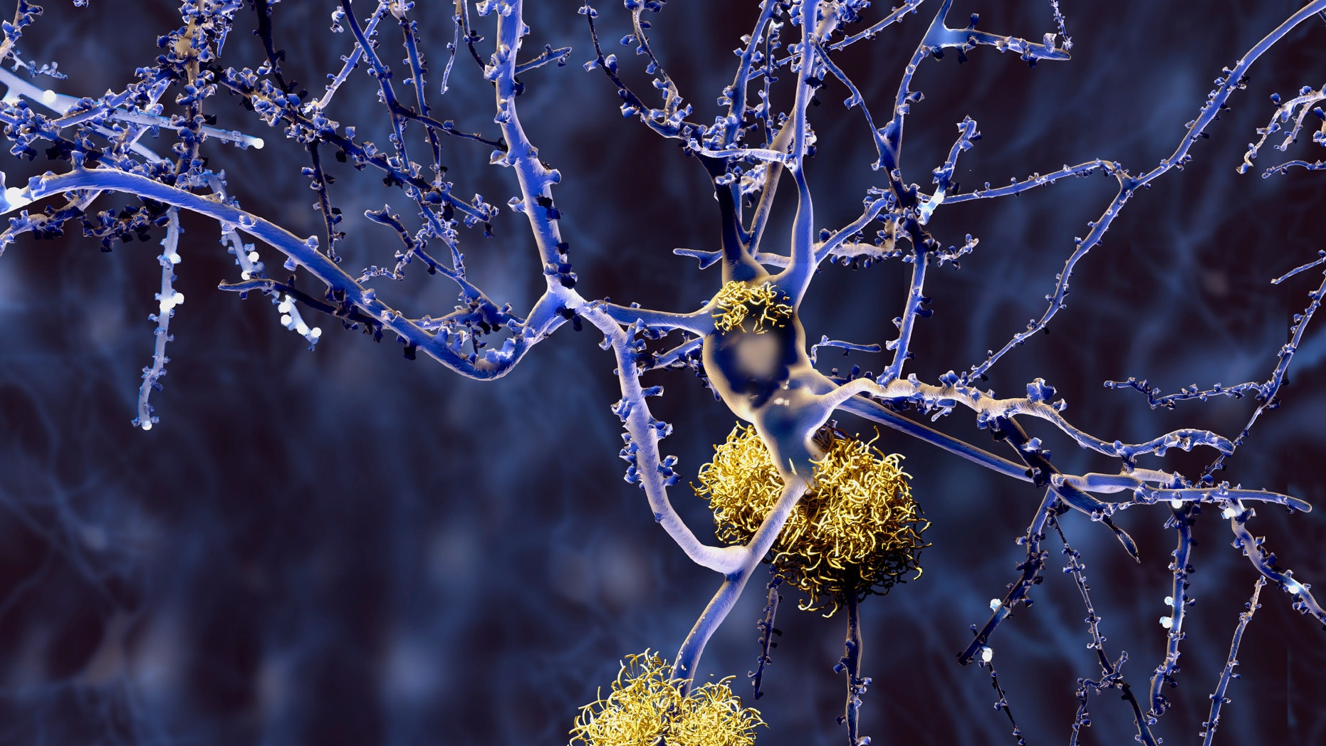 An image of amyloid plaques.
