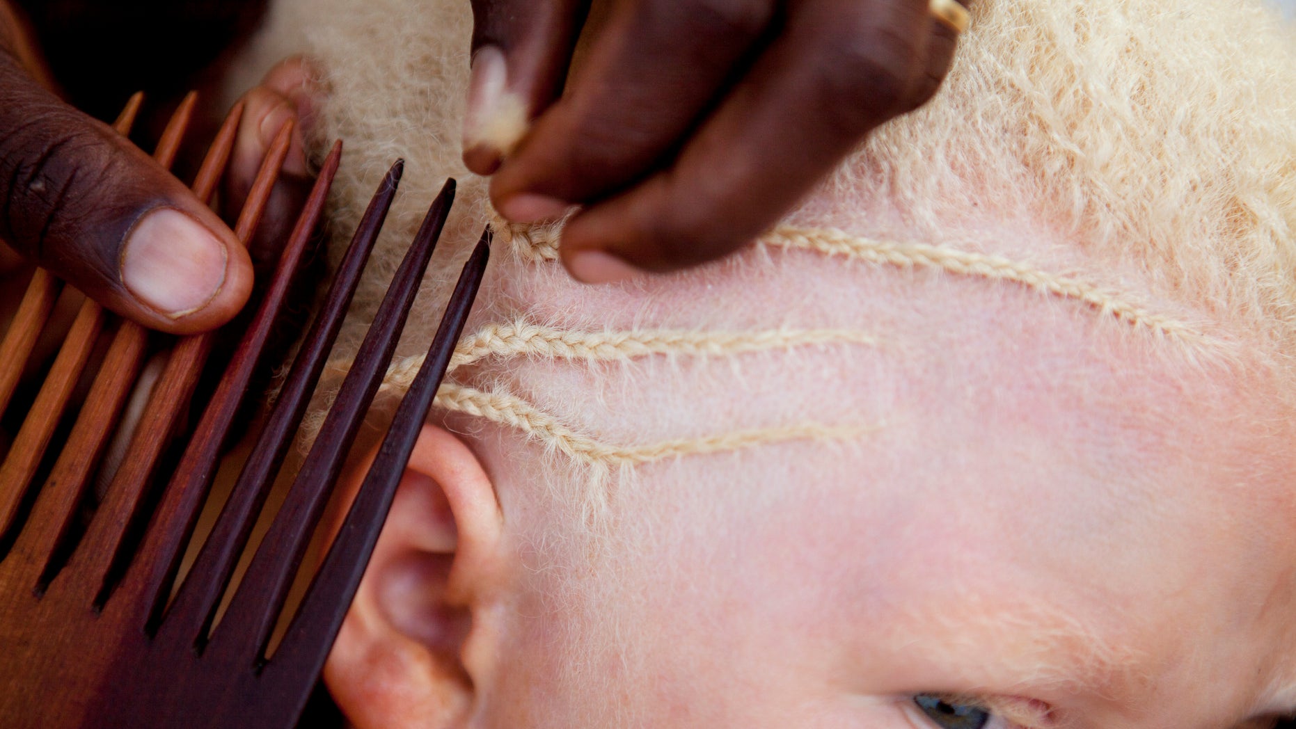 A young girl getting her hair braided at a facility acting as a safe haven for children with albinism in Tanzania.