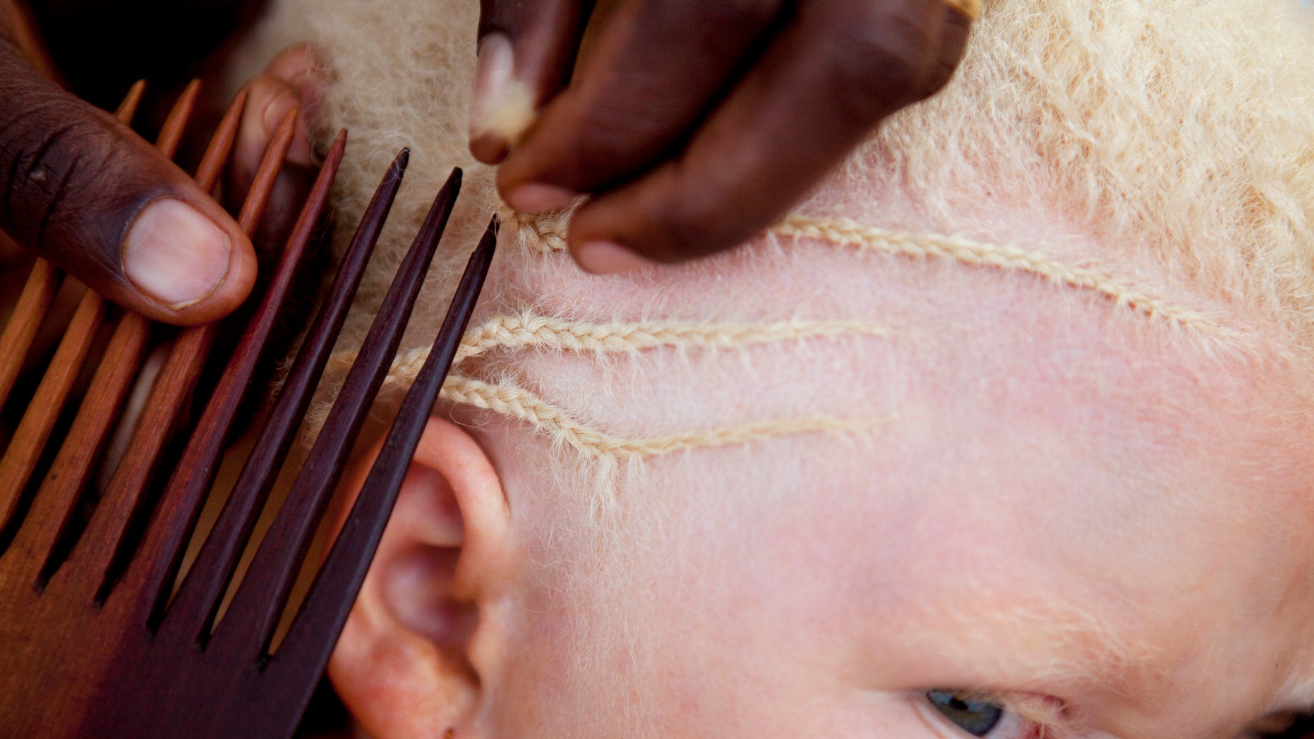 A young girl getting her hair braided at a facility acting as a safe haven for children with albinism in Tanzania.