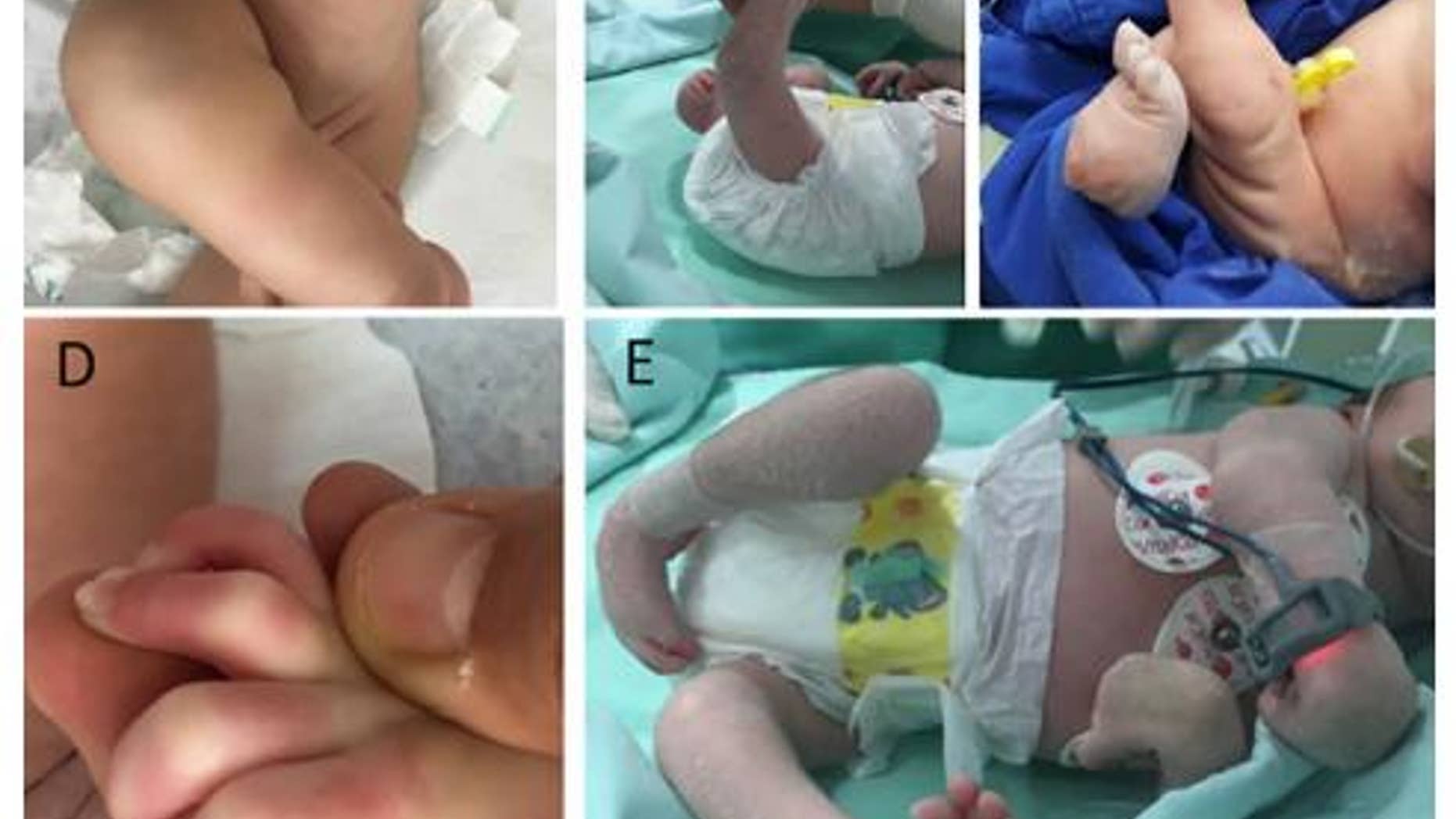 Clinical pictures of children with arthrogryposis.