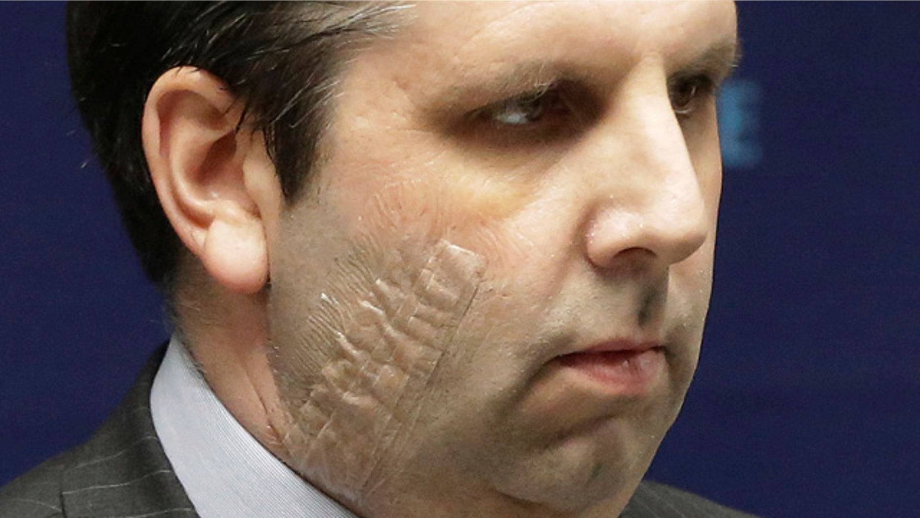 March 10, 2015: U.S. Ambassador to South Korea Mark Lippert listens to a question during a press conference before being discharged from Severance Hospital in Seoul. Lippert left the hospital Tuesday after five days for treatment of injuries caused by a knife attack. (AP Photo/Ahn Young-joon)