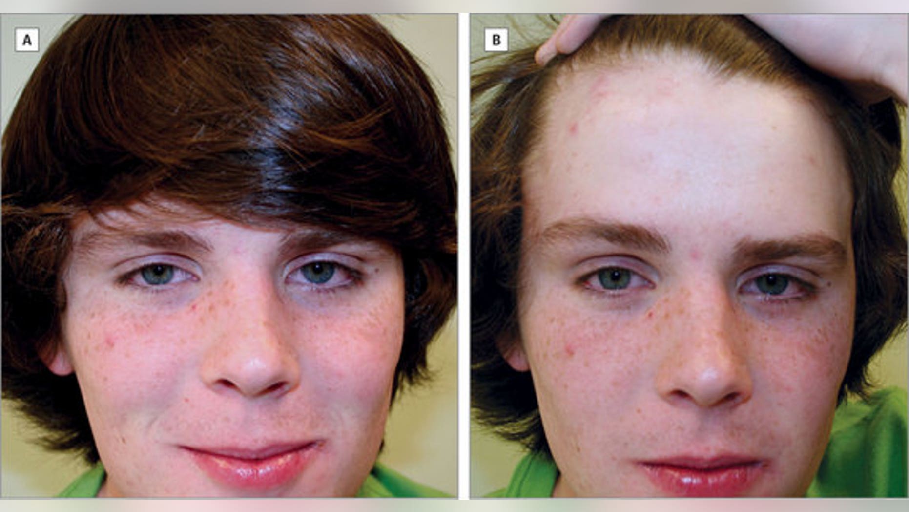 A teen with a hairstyle similar to that of celebrity Justin Bieber shows how the skin typically covered by bangs has less sun damage than the skin on the cheeks and face. Doctors say that this hairstyle can be used to teach kids about the skin