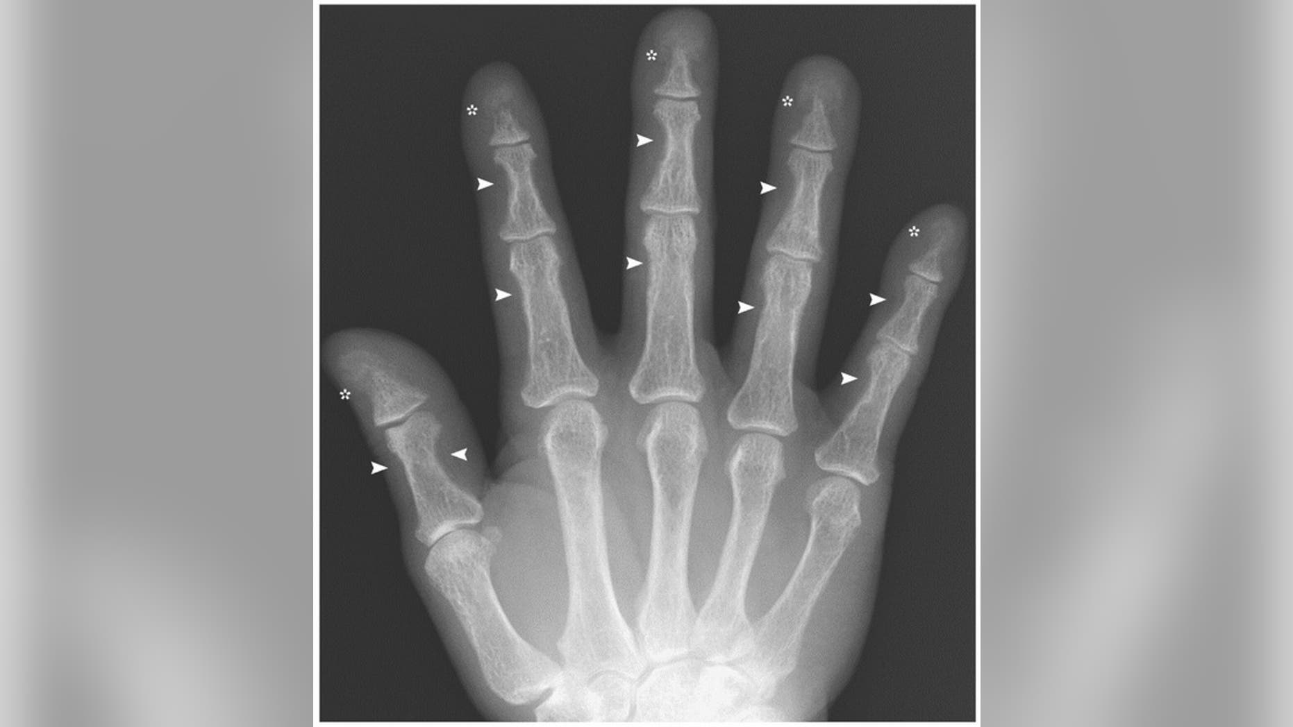 A hand X-ray shows bone loss in fingers, a sign of overactive parathyroid glands.
