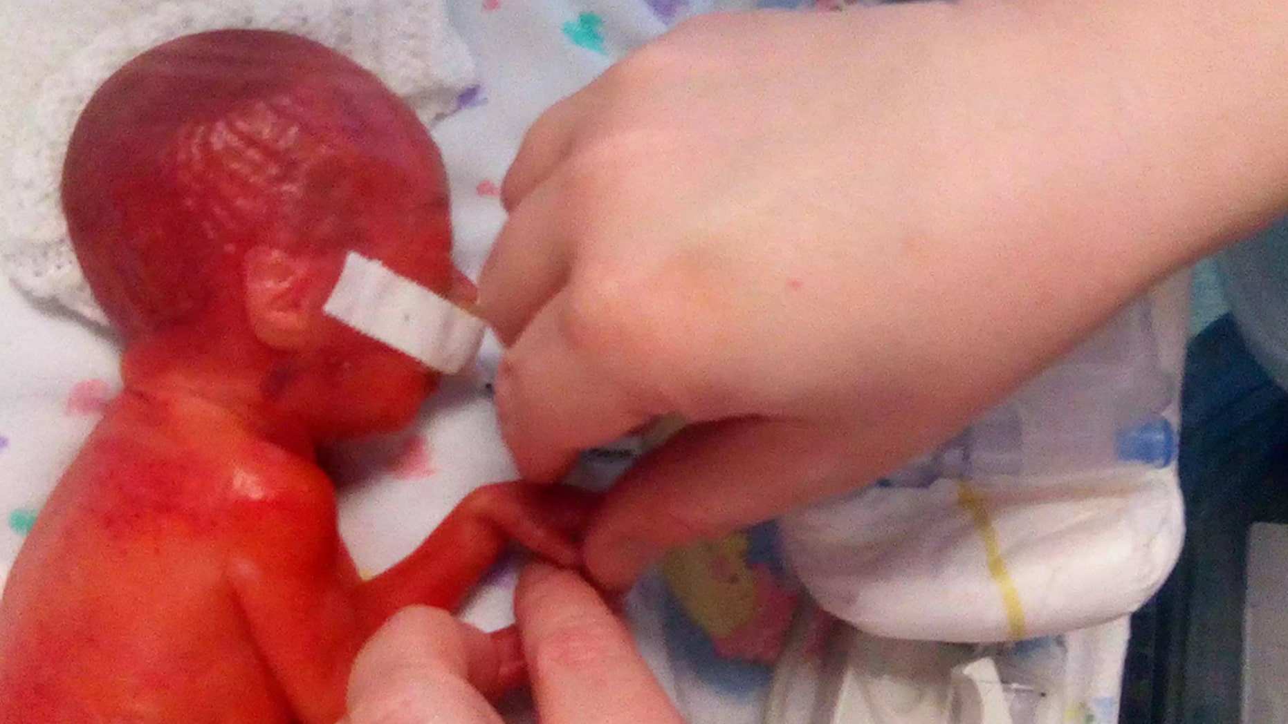 Baby Hailie Dillon was born so premature that her brain was visible through her transparent skin.
