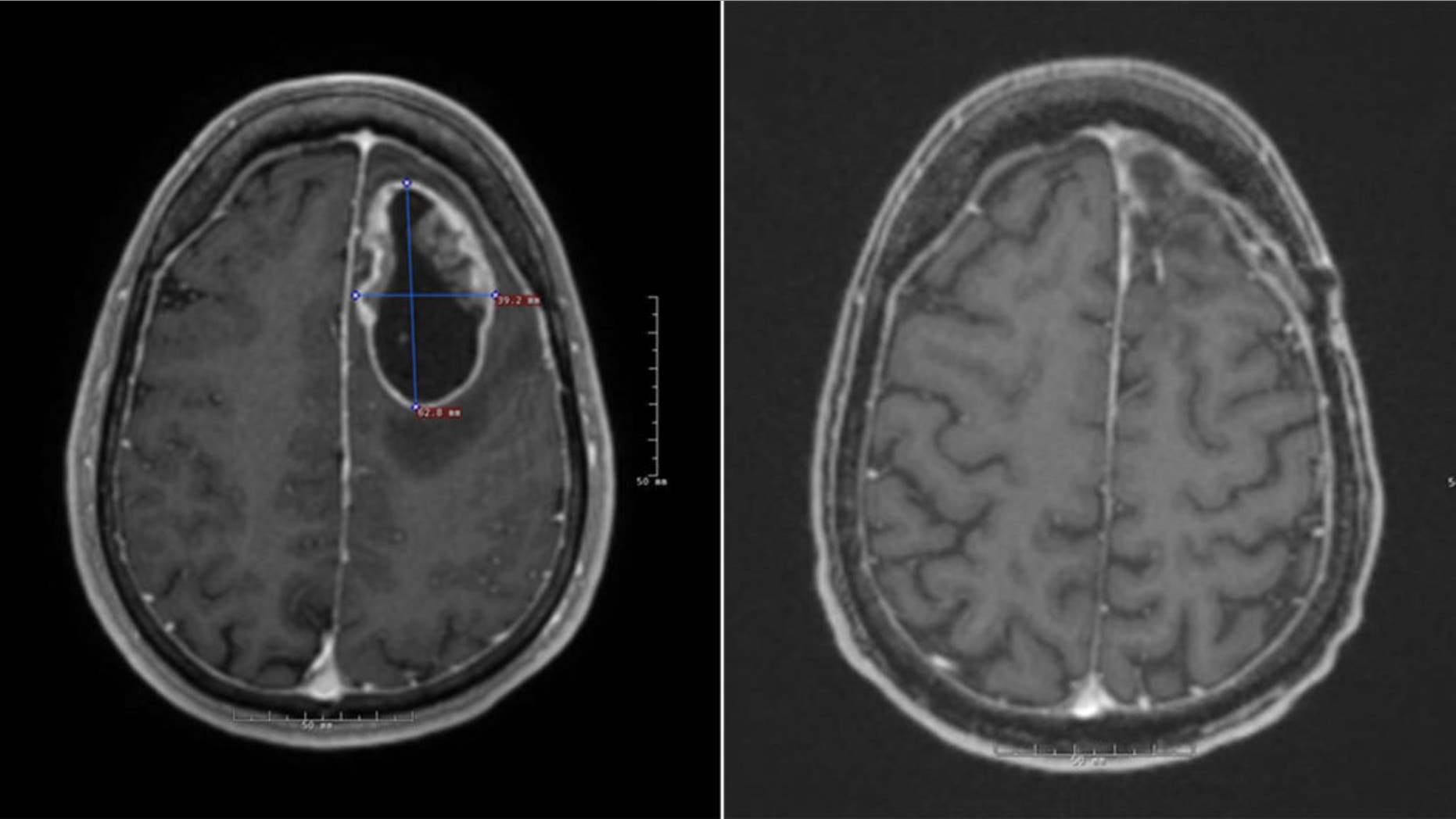 Jeff Tabor had surgery to remove the tumor, pictured left, and then underwent six weeks of radiation before beginning the clinical trial. His most recent scans, pictured right, show no signs of regrowth.