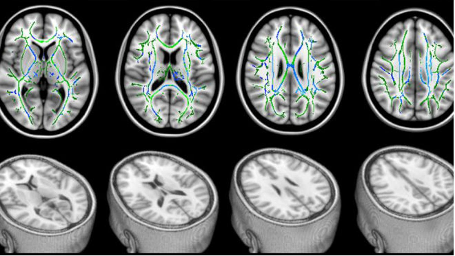 In these DTI scans, the bottom row shows views of a head with the top sliced away to reveal the brain. The top row shows the corresponding top views of the brain. The green lines represent the white matter— the brain’s “wiring.” The blue areas are the damaged parts of the white matter that seem to be responsible for cognitive problems experienced by study patients with mild traumatic brain injury. (Professor Blamire/Newcastle University, UK)