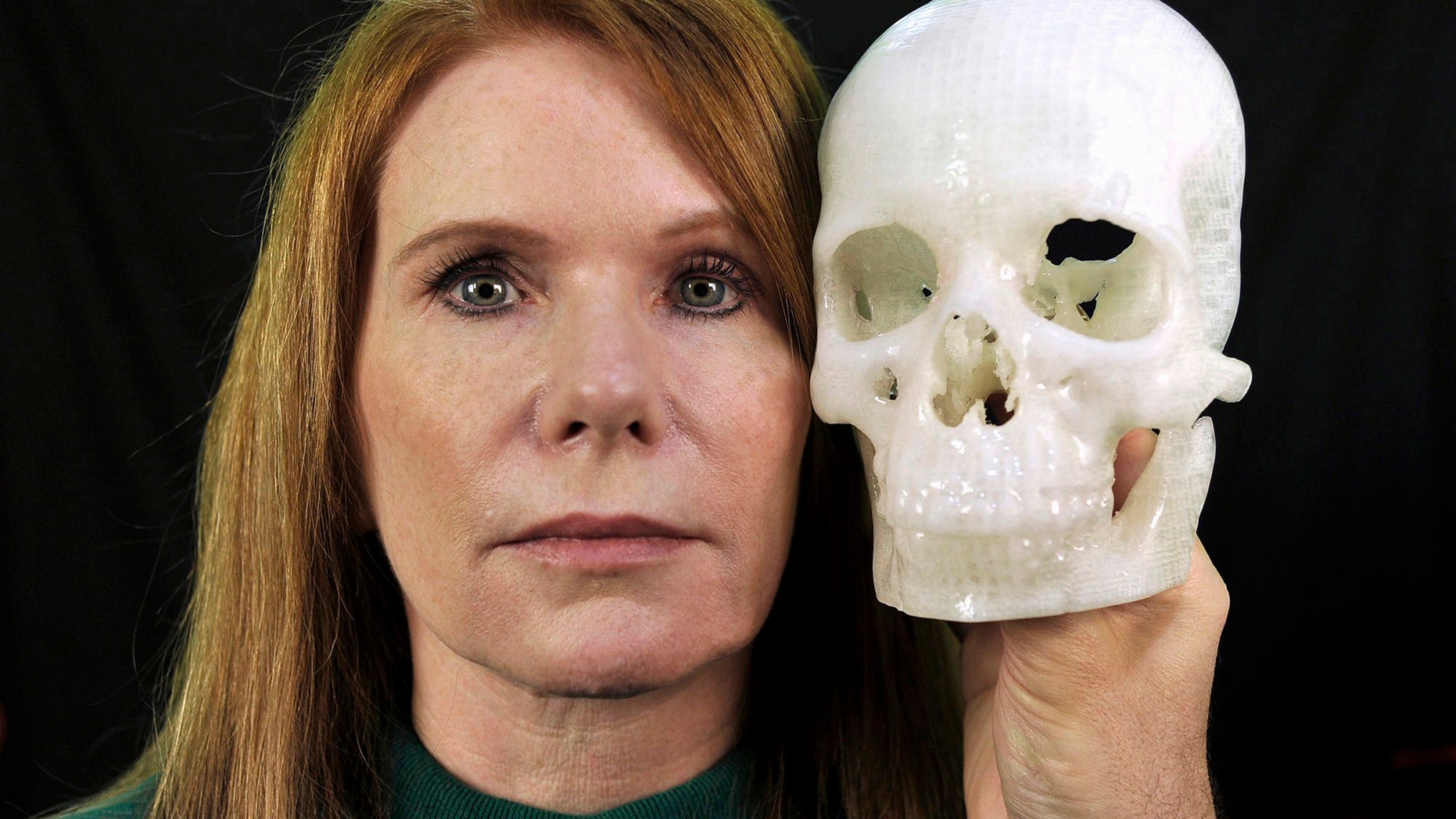 In this photo taken Jan. 13, 2015, Pamela Shavaun Scott holds a 3D printer model of her skull after her brain tumor was removed from behind her eye, in Morro Bay, Calif. (AP Photo/Phil Klein)
