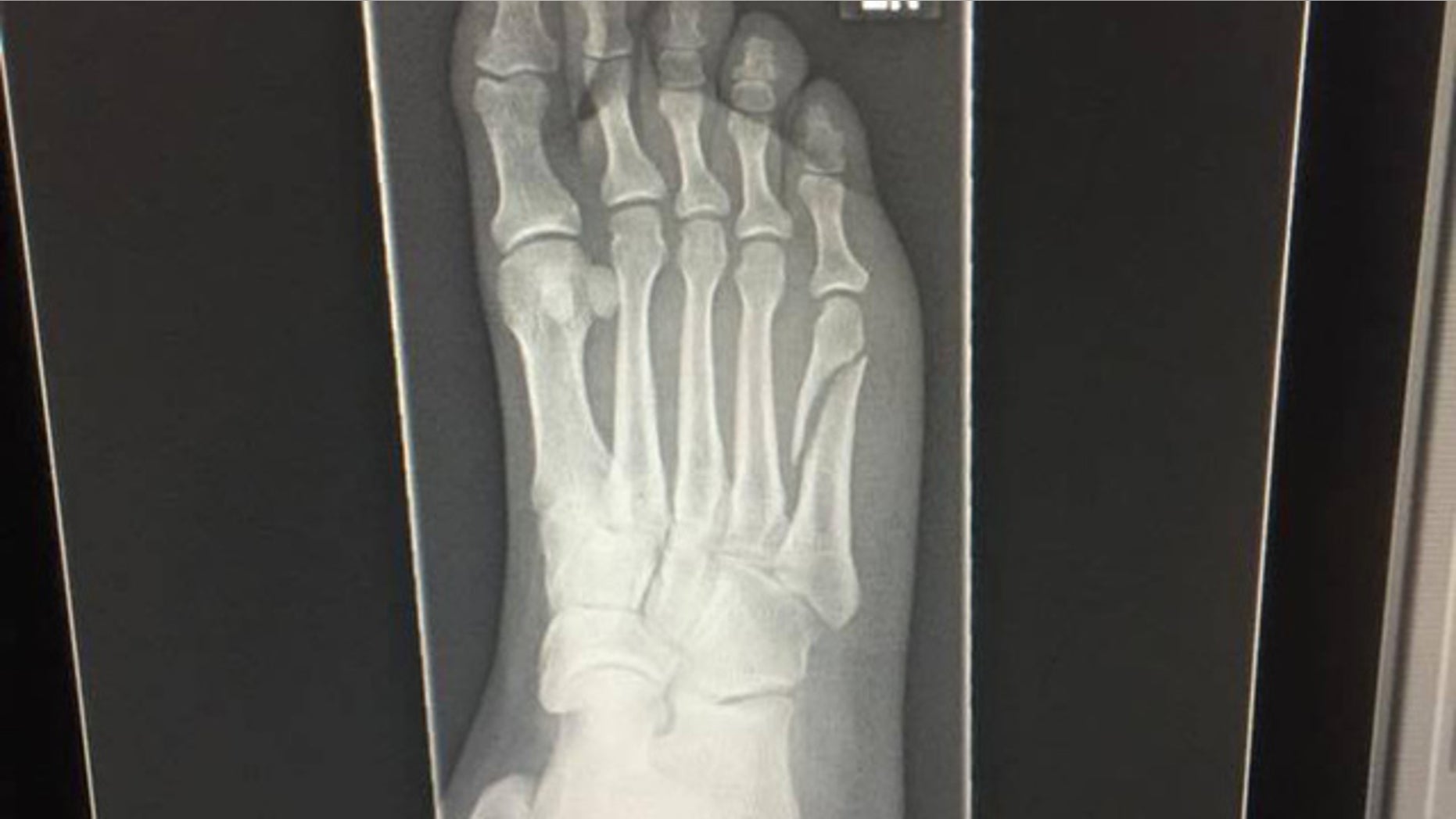 Diana Vadala said she broke her foot while celebrating the Patriots win.
