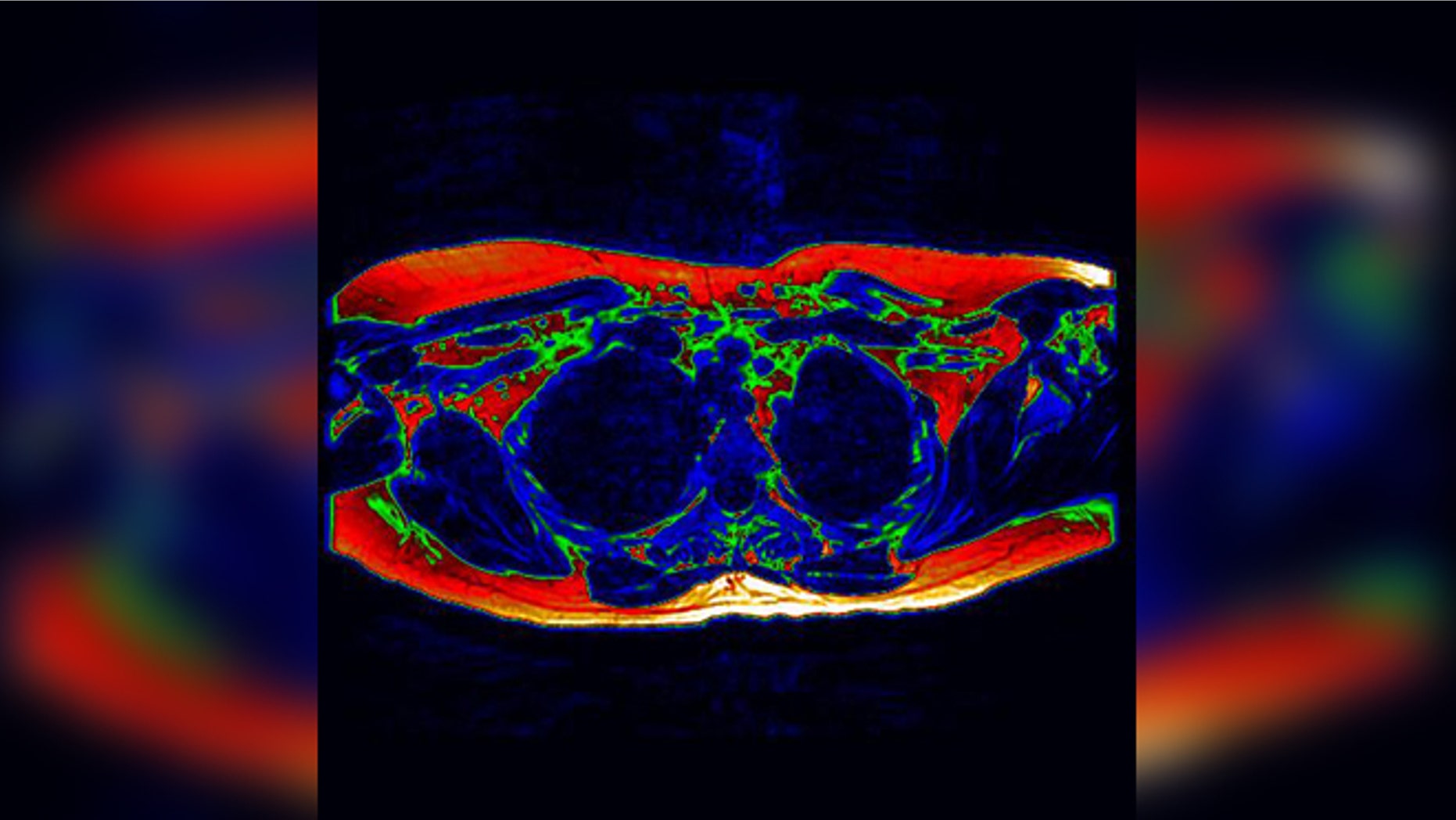 Digitally-enhanced axial MRI of the upper chest (as if viewed from the feet). Areas of potential brown fat are shown in green. (University of Warwick)