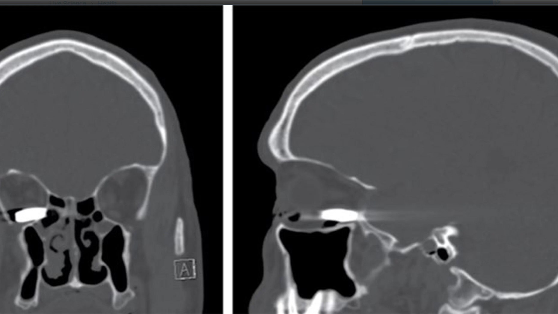 The 45-year-old man went to the emergency room after he was shot with a .22 caliber pistol.
