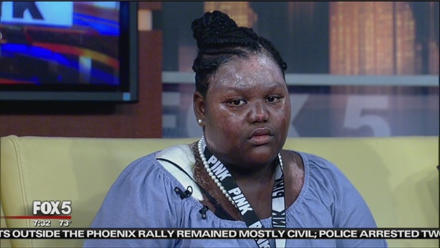 Jamoneisa Merritt suffered second- and third-degree burns during a sleepover prank.
