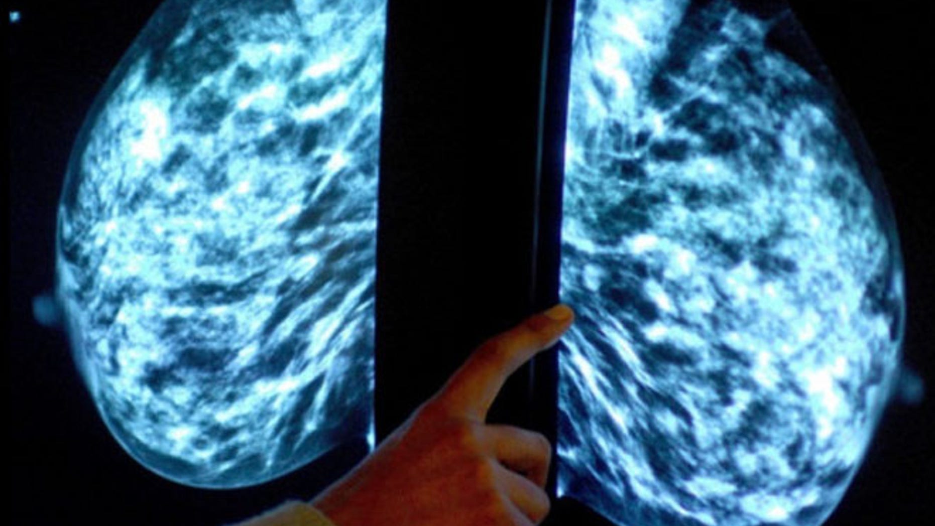 A new report found that the long suspected breast cancer cluster near San Francisco may be more myth than medicine. (Associated Press)