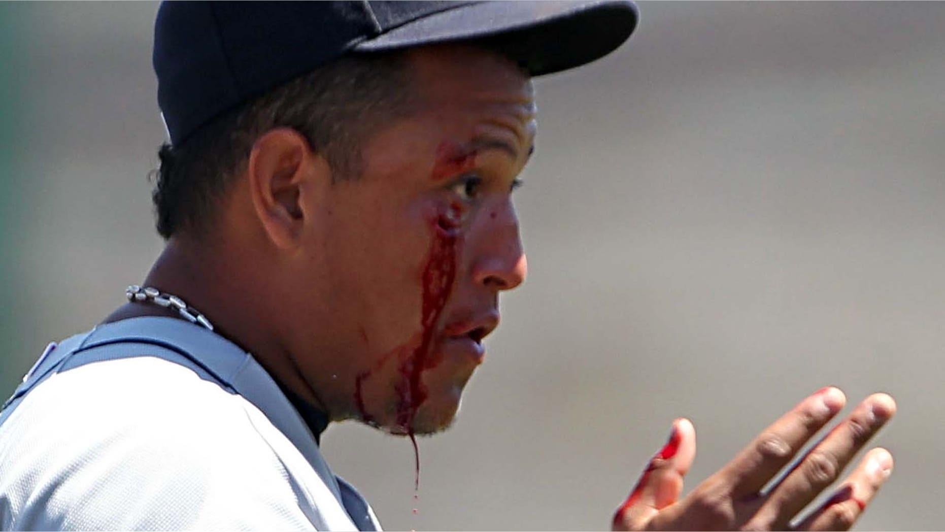 Detroit Tigers third baseman Miguel Cabrera after he was hit in the face by a grounder May 19th.