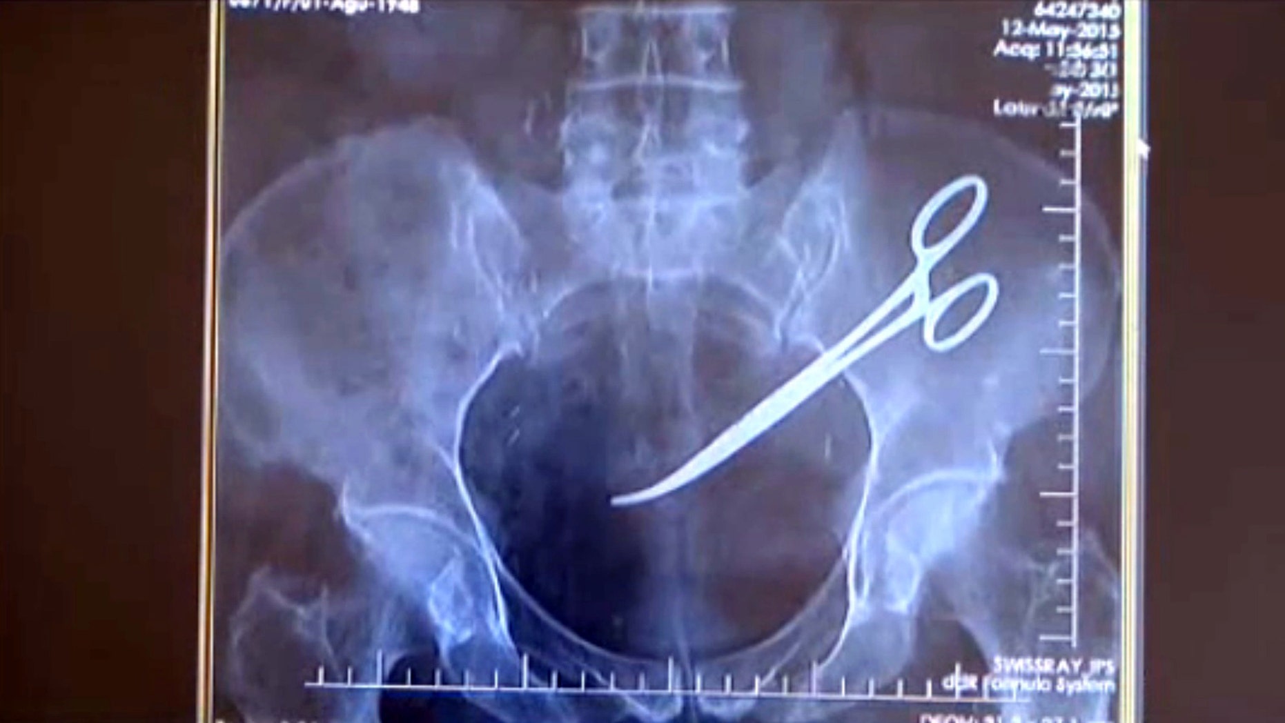 Woman Suing After Doctors Leave Surgical Scissors In Abdomen Fox News