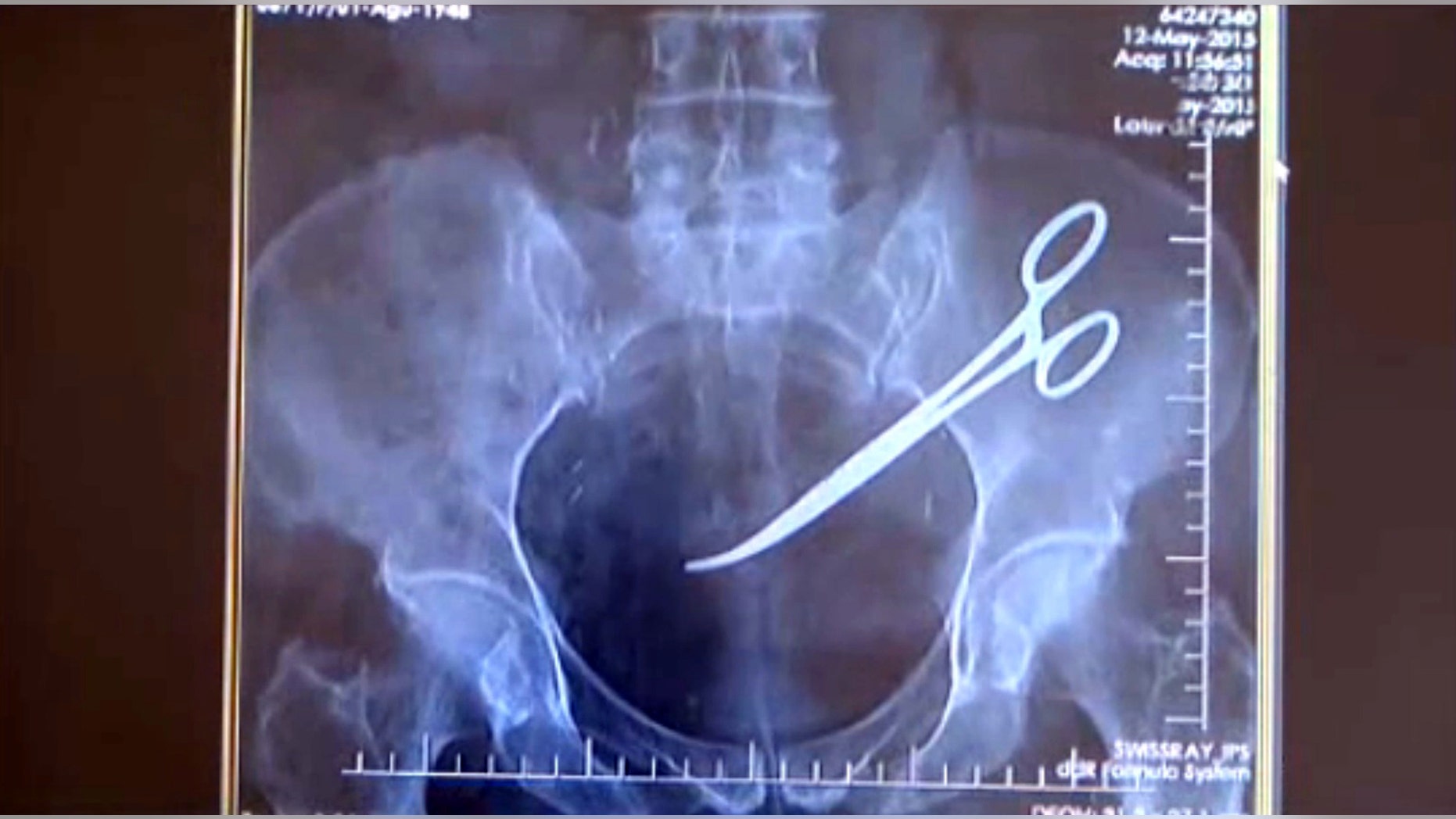 A Turkish woman was shocked to learn doctors had left scissors in her abdomen after surgery