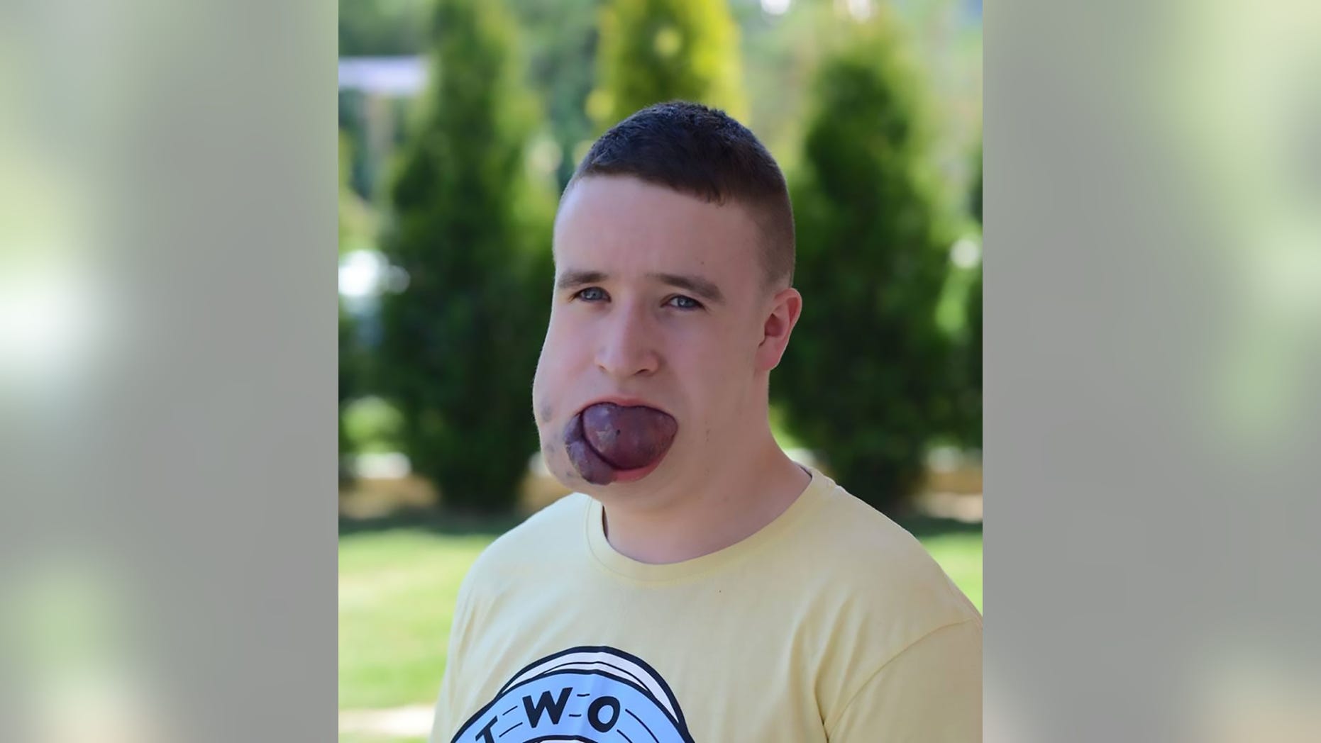 Krzysztof Wegrzyn, 18, was born with the benign tumor haemangioma.