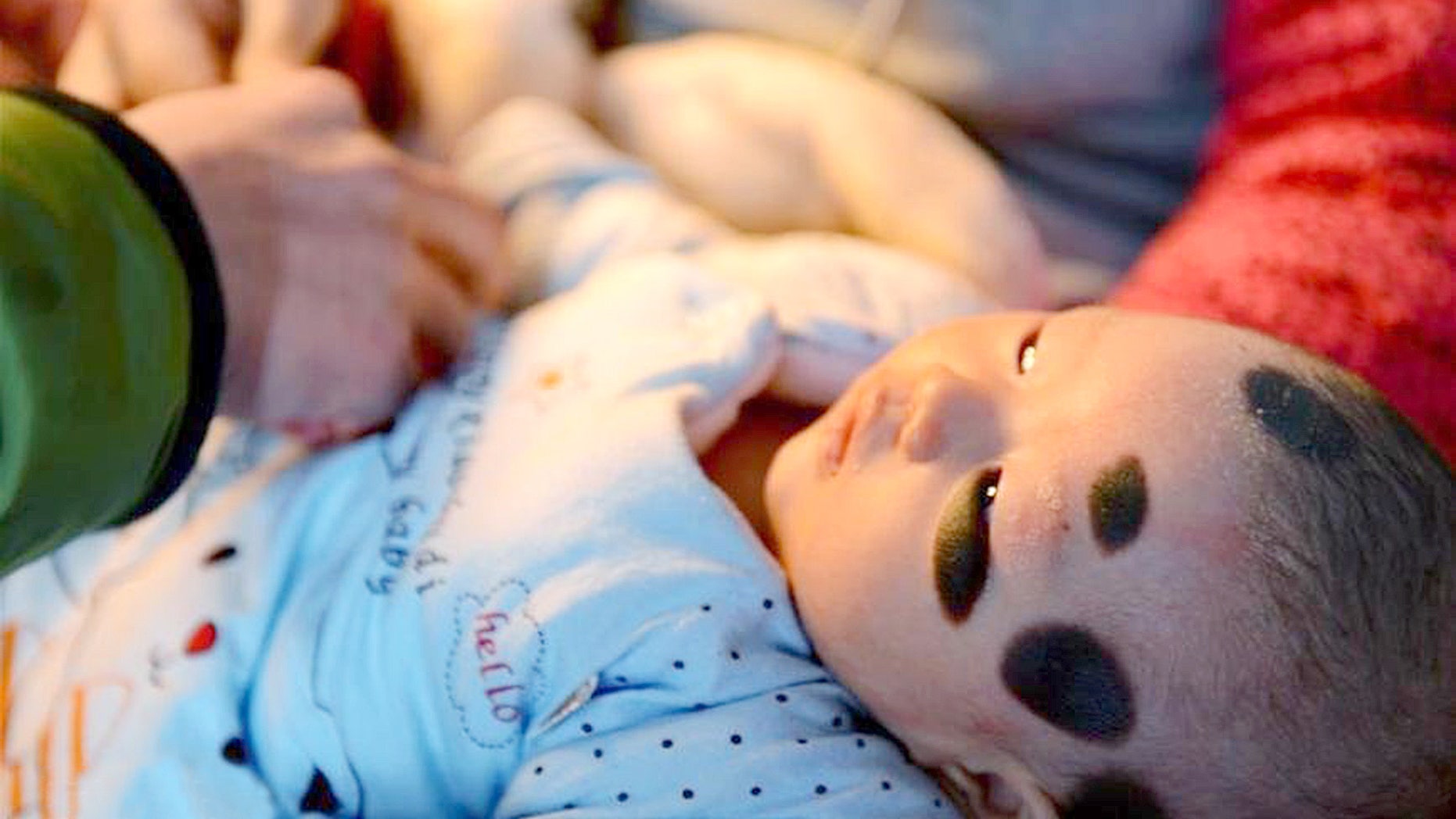 Wu Zimiao was born with a rare condition that left her covered in large black moles.