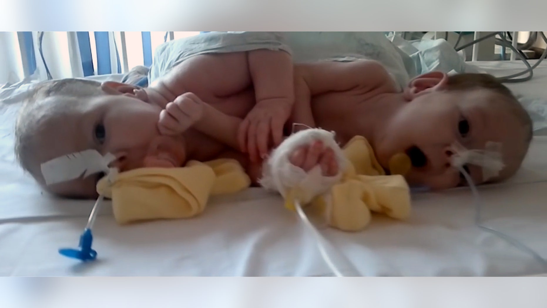 Doctors say they have successfully separated conjoined twins after a 10 hour operation by a team of 20 surgeons.