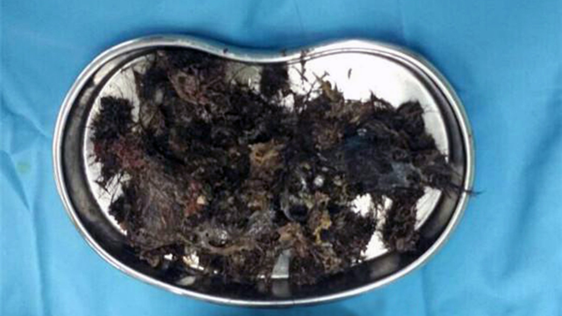 Pic shows: The hairball removed from Miao Miaoâs stomach
Doctors have removed a giant hairball from a little girl after it took up two-thirds of her stomach.
Miao Miao, the five-year-old girl from Qingdao City, in East Chinaâs Shandong Province, was hospitalised after complaining of stomach pains to her parents.
Subsequent scans done at the Qingdao Women and Infantâs Hospital shocked Miao Miaoâs parents her doctors after they revealed a dark mass inside her, taking up approximately two-thirds of her stomach.
The girl was taken into surgery where doctors removed the giant hairball, which had hardened inside her over time which caused blockages and later pain.
Doctor Jiang Xianmin noted that Miao Miao had most likely been eating her own hair for a period of six to 12 months, and that the behaviour was consistent with a condition known as allotriophagy.
It refers to a patient â especially young in age â who has a craving for unusual substances, similar to another condition known as "pica", but without the tendency to eat things such as chalk, metal, glass, ash and the like.
During consultations with doctors at the hospital, Miao Miao told her parents that she often ate her hair when she could not fall asleep during naps at her nursery school.
Doctor Jiang also noted that it would have been common for Mia Miao â a shy girl â eat her hair whenever nervous.
Psychologists at the hospital told Miao Miaoâs parents that children between the ages of three and six were more likely to eat unusual substances.
They have been asked to pay more attention to their daughterâs daily habits.
(ends)