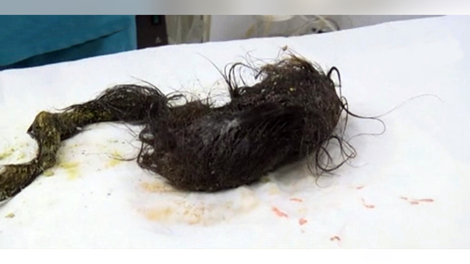 The 11-year-old, from Taraz, in southern Kazakhstan, consumed so much hair from her own head that the mass filled nearly 7 inches of her stomach and continued about 14 inches into her bowel.