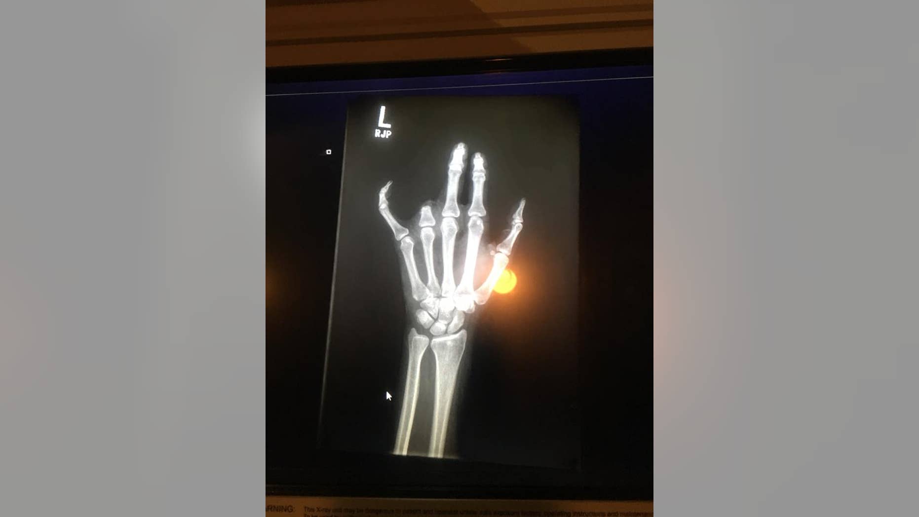 This mom lost her finger after it got caught on a fence at her son's T-ball practice.