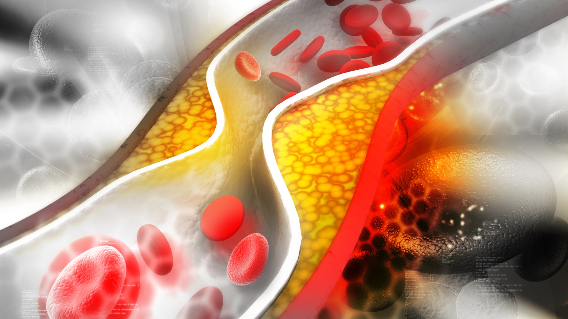Cholesterol plaque in an artery.