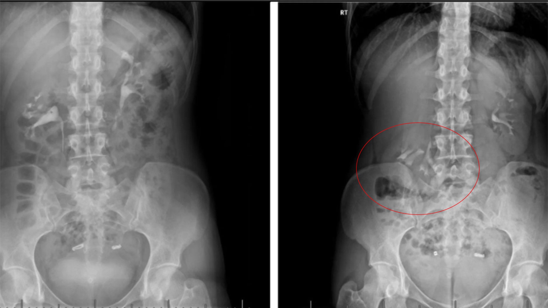 In the scan on the left, taken when the woman was lying down, her kidneys appear at the same level on both sides of her spine. In the scan on the right, taken when the woman was standing upright, her right kidney (circled on the left in the scan) falls into the pelvis.