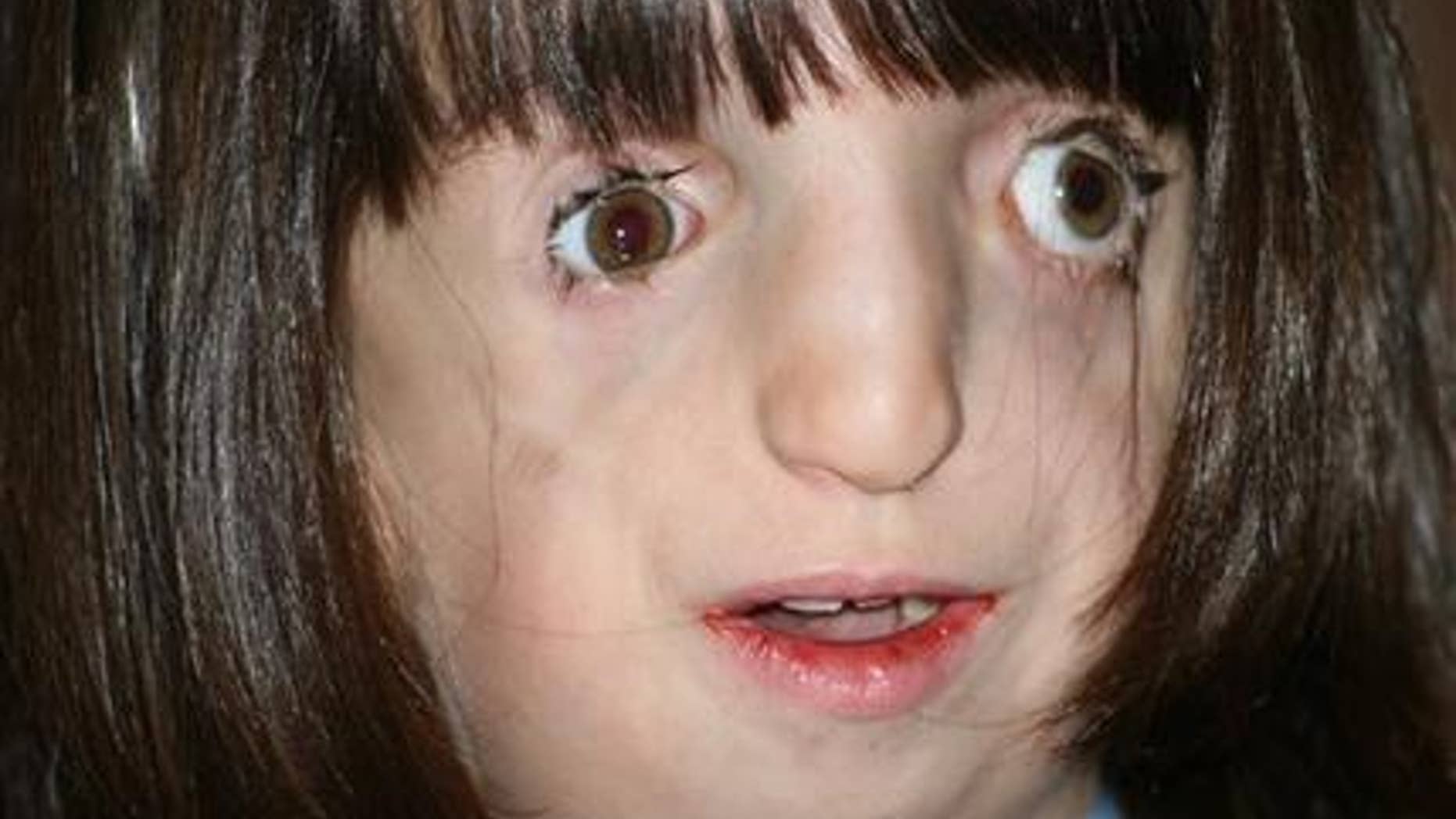 In this Feb. 22, 2012 photo, Clara Beatty, 9, looks at her mother while doing homework at their Winnetka, Ill., home. The fourth-grader was born with facial deformities, including underdeveloped cheekbones and a small jaw, caused by a genetic mutation called Treacher Collins syndrome. (AP Photo/Martha Irvine)