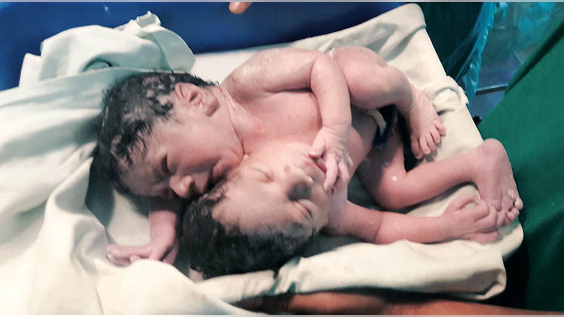The conjoined twins were born sharing every vital organ but their brains.