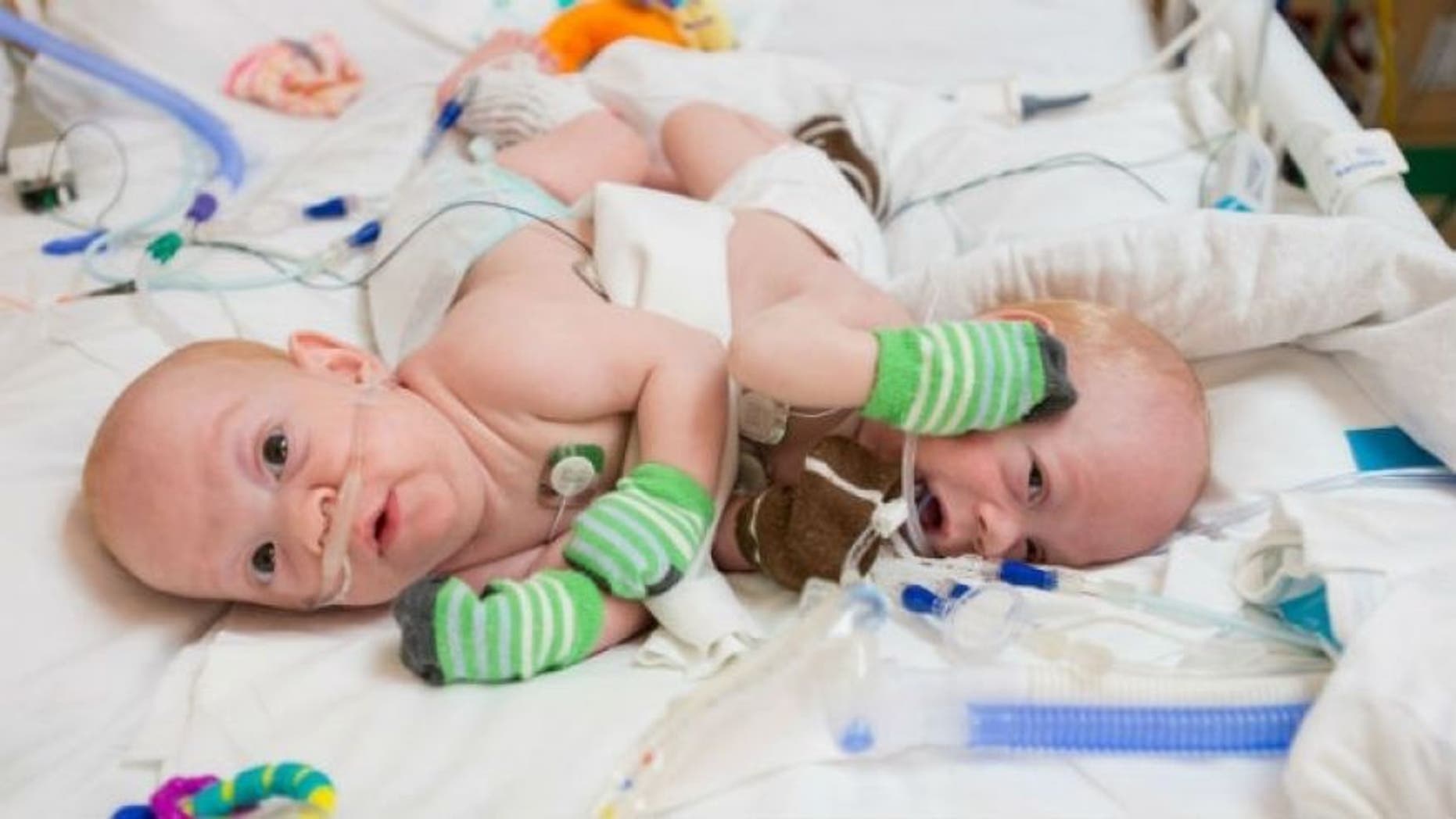 Conner and Carter Mirabal are pictured before their separation surgery.