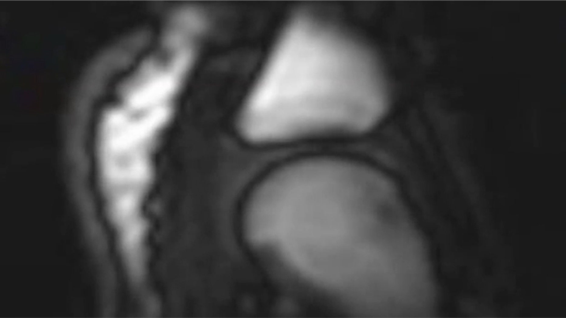 As the joint surfaces suddenly separate, there is no more fluid available to fill the increasing joint volume, so a cavity is created, and that event is what's associated with the sound.