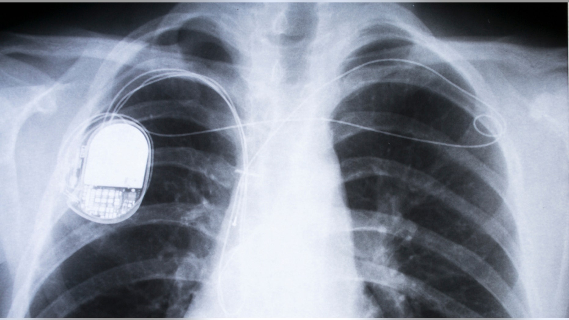 In late March, the DHS warned that computer hackers can easily gain access to implanted cardiac defibrillators made by Medtronic.<br data-cke-eol="1">